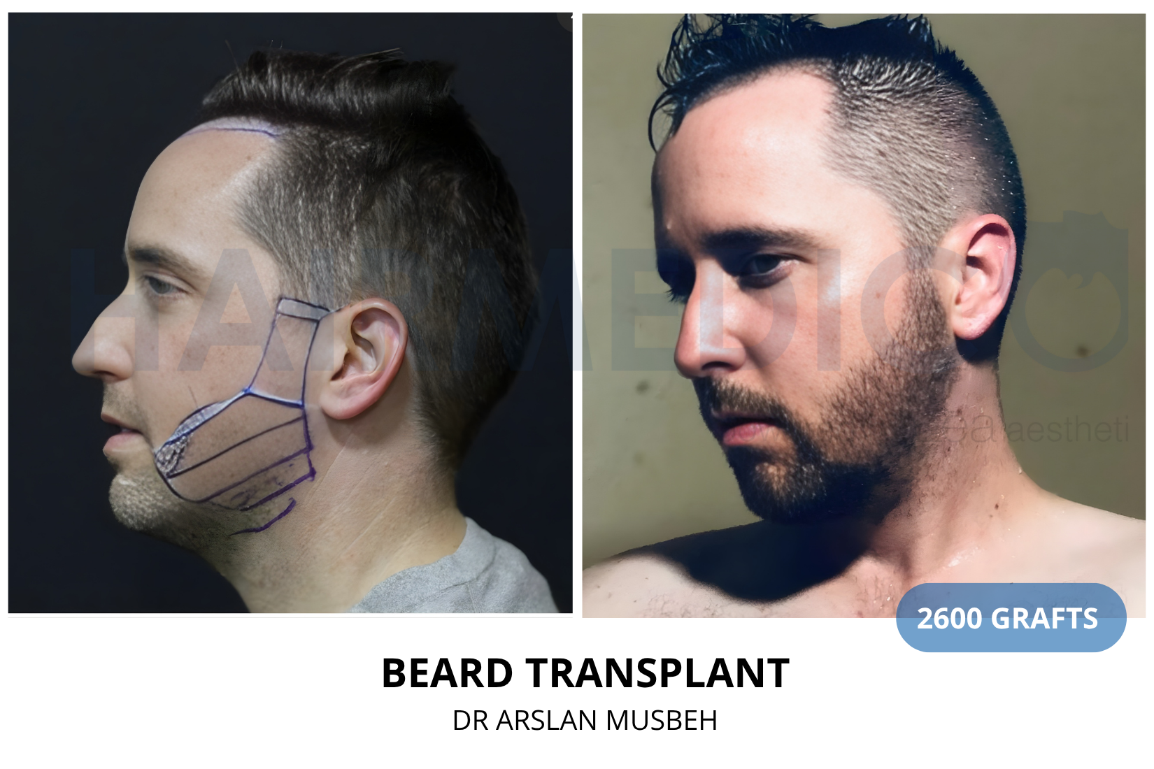 Risultato trapianto di barba, 2600 graft, Dr. Arslan Musbeh