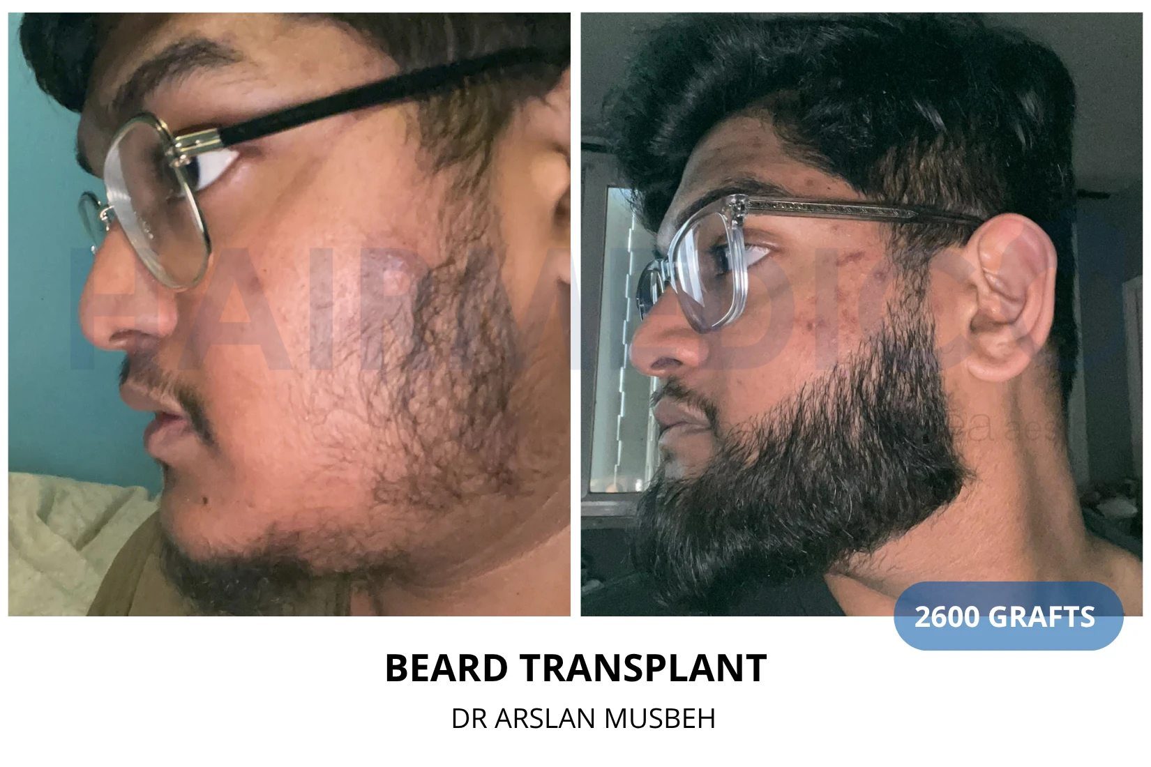 Hair transplant 2500 grafts FUE before and after at Hairmedico clinic by Dr. Arslan Musbeh in Istanbul