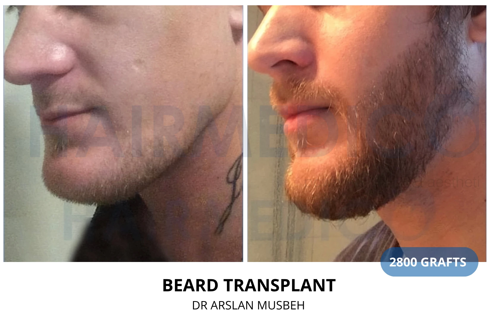 Hair transplant 3100 grafts FUE before and after at Hairmedico clinic by Dr. Arslan Musbeh in Istanbul
