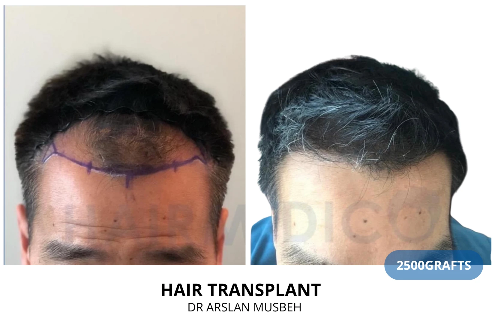 Hair transplant 3200 grafts FUE before and after at Hairmedico clinic by Dr. Arslan Musbeh in Istanbul