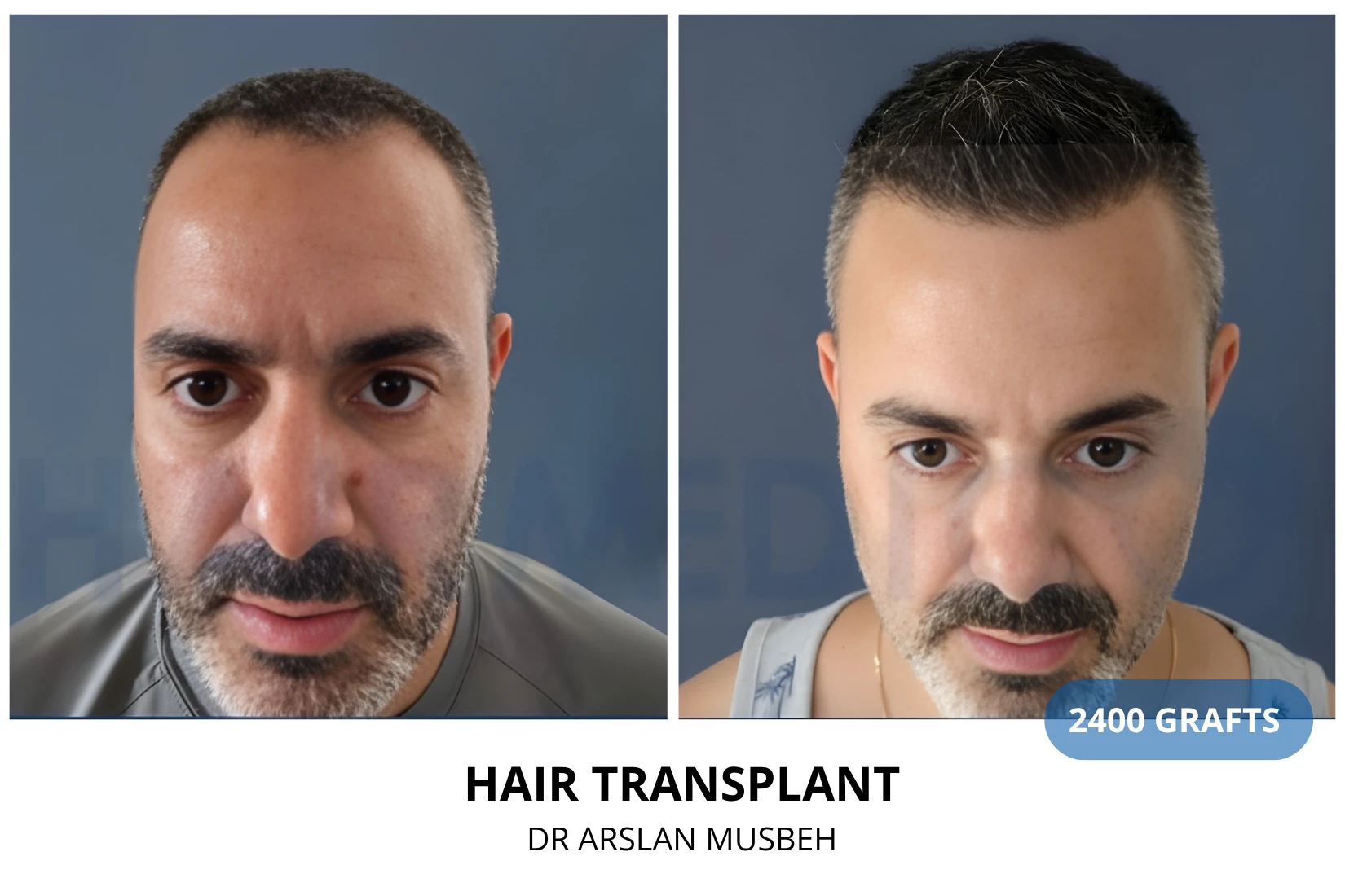 Hair transplant 2700 grafts FUE before and after at Hairmedico clinic by Dr. Arslan Musbeh in Istanbul