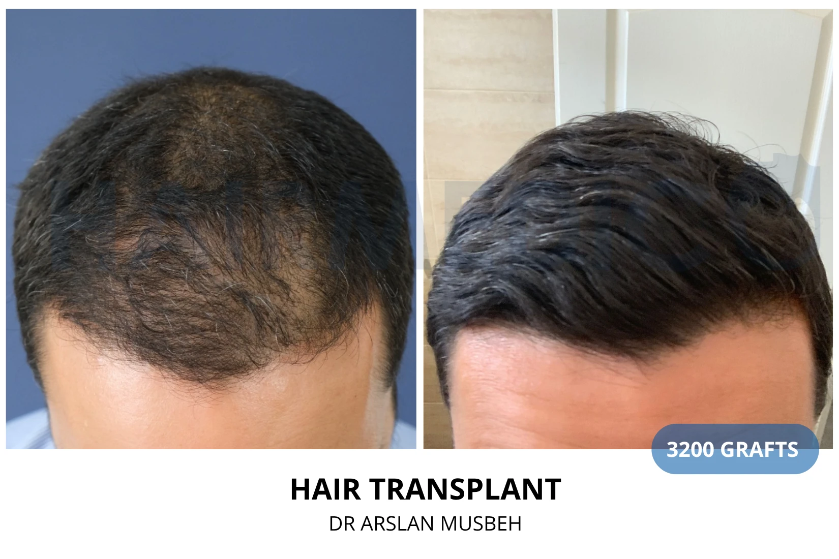 Hair transplant 2800 grafts FUE before and after at Hairmedico clinic by Dr. Arslan Musbeh in Istanbul