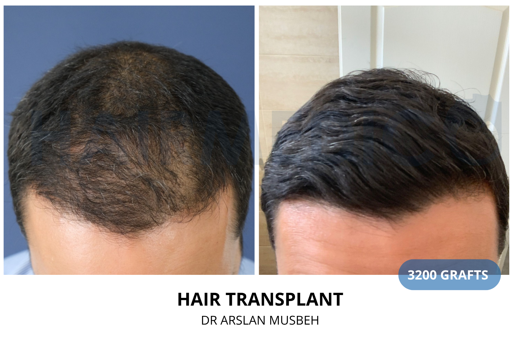 Risultato trapianto di capelli, 3200 graft, Dr. Arslan Musbeh