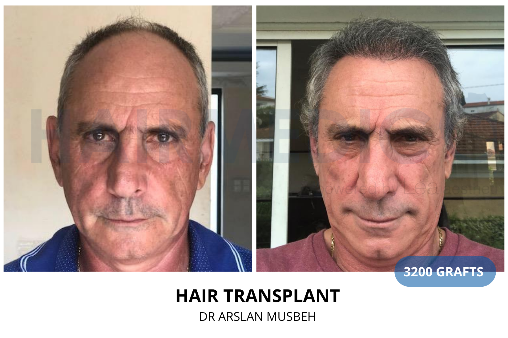 Risultato trapianto di capelli, 3200 graft, Dr. Arslan Musbeh
