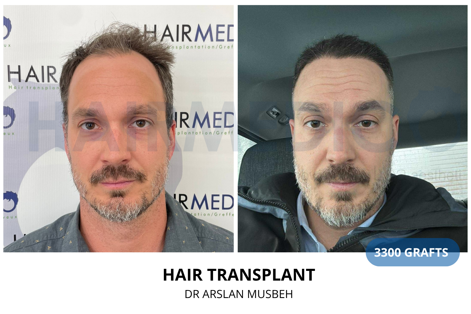 Risultato trapianto di capelli, 3300 graft, Dr. Arslan Musbeh