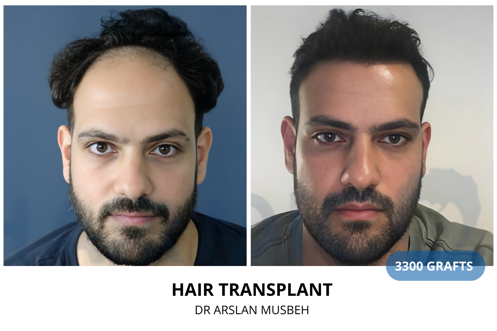 Risultato trapianto di capelli, 3300 graft, Dr. Arslan Musbeh