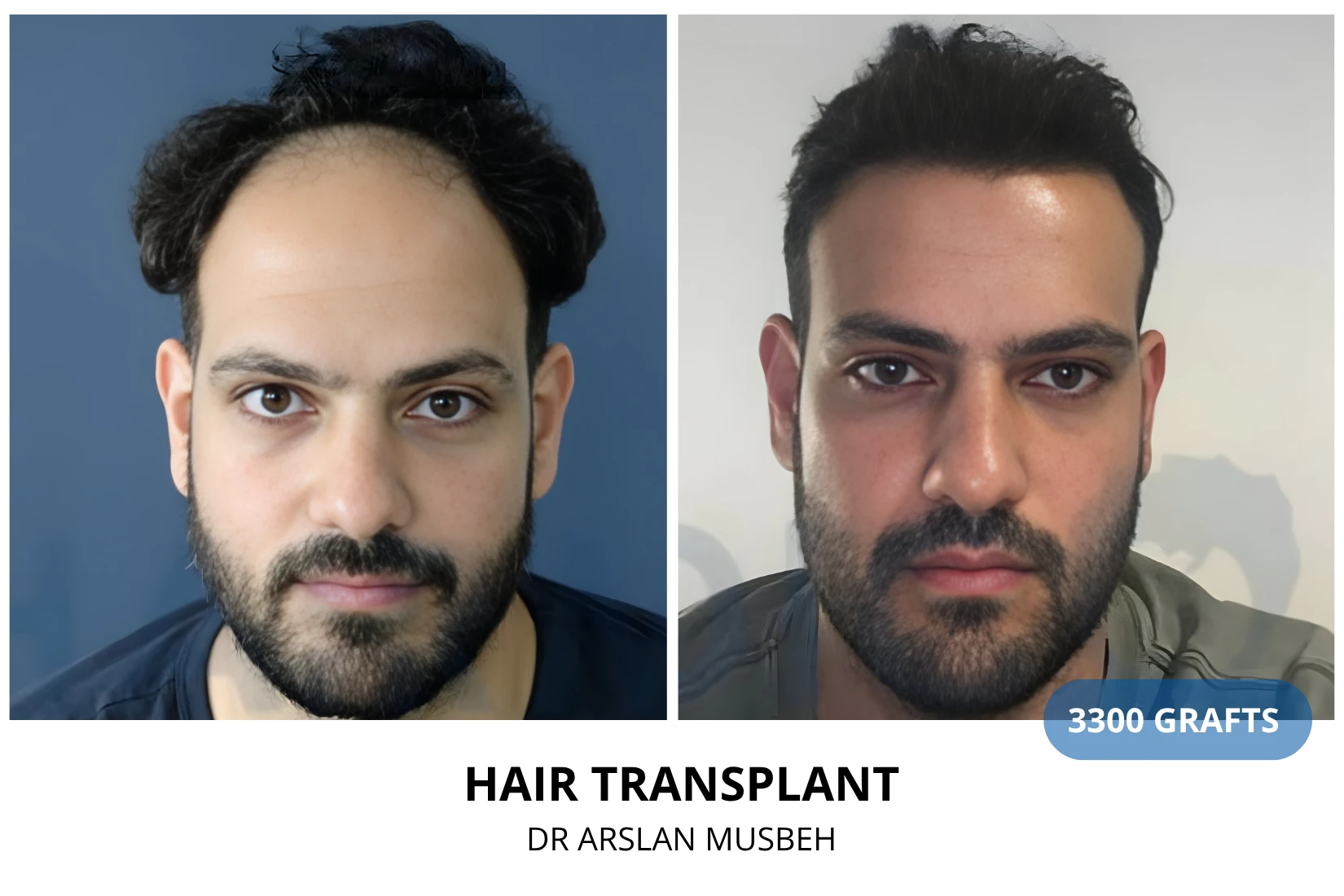 Hair transplant 2800 grafts FUE before and after at Hairmedico clinic by Dr. Arslan Musbeh in Istanbul