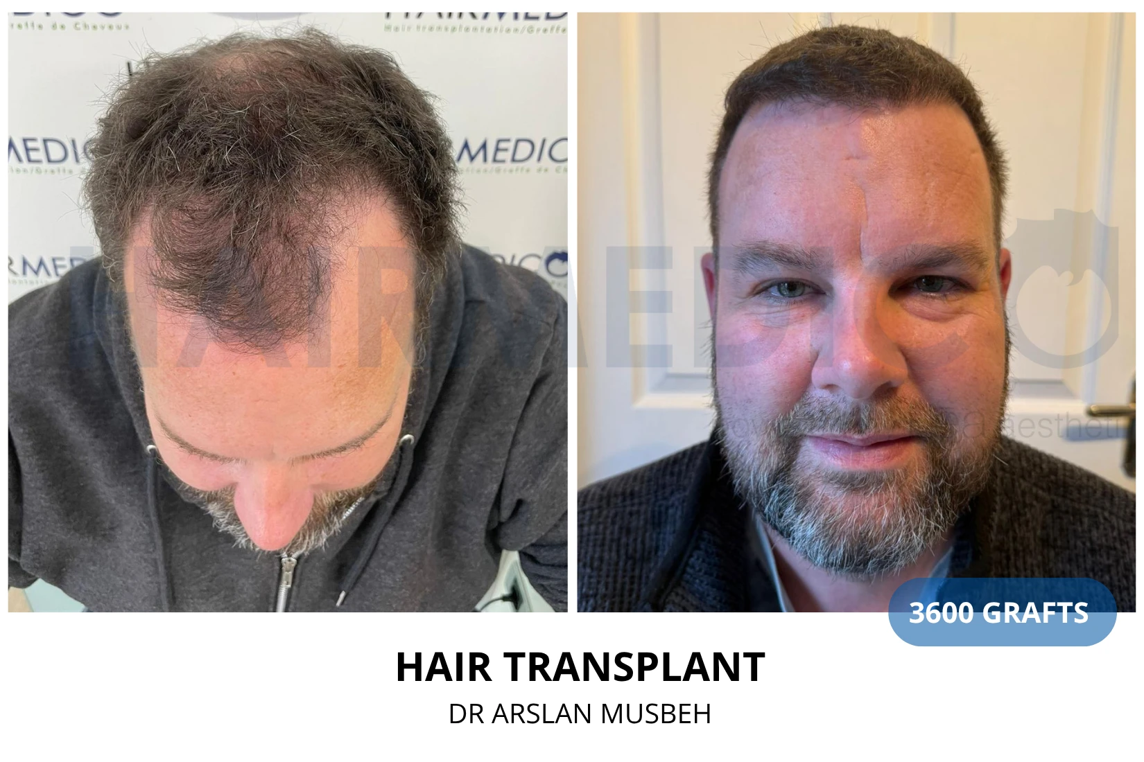 Hair transplant 3100 grafts FUE before and after at Hairmedico clinic by Dr. Arslan Musbeh in Istanbul