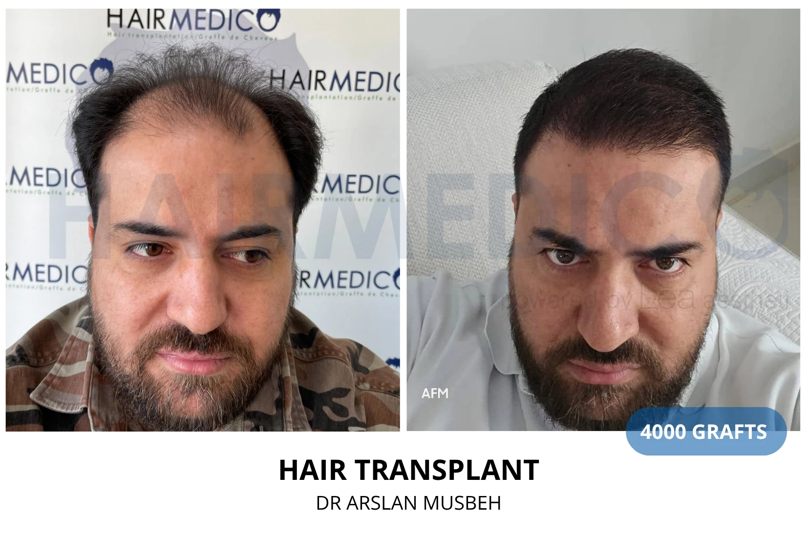 Hair transplant 3100 grafts FUE before and after at Hairmedico clinic by Dr. Arslan Musbeh in Istanbul
