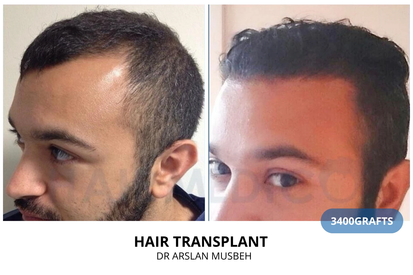 Hair transplant 3200 grafts FUE before and after at Hairmedico clinic by Dr. Arslan Musbeh in Istanbul
