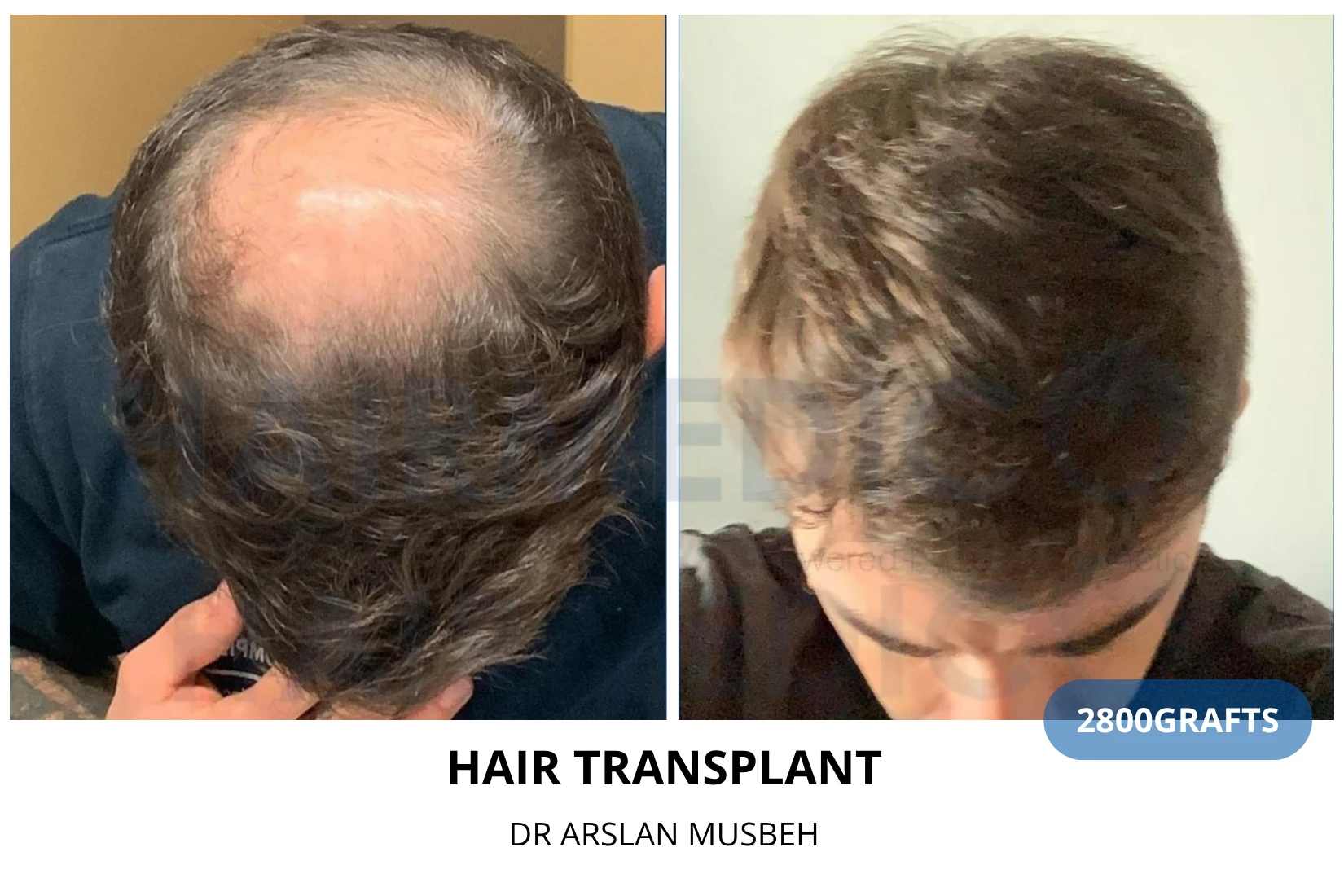 Hair transplant 3200 grafts FUE before and after at Hairmedico clinic by Dr. Arslan Musbeh in Istanbul