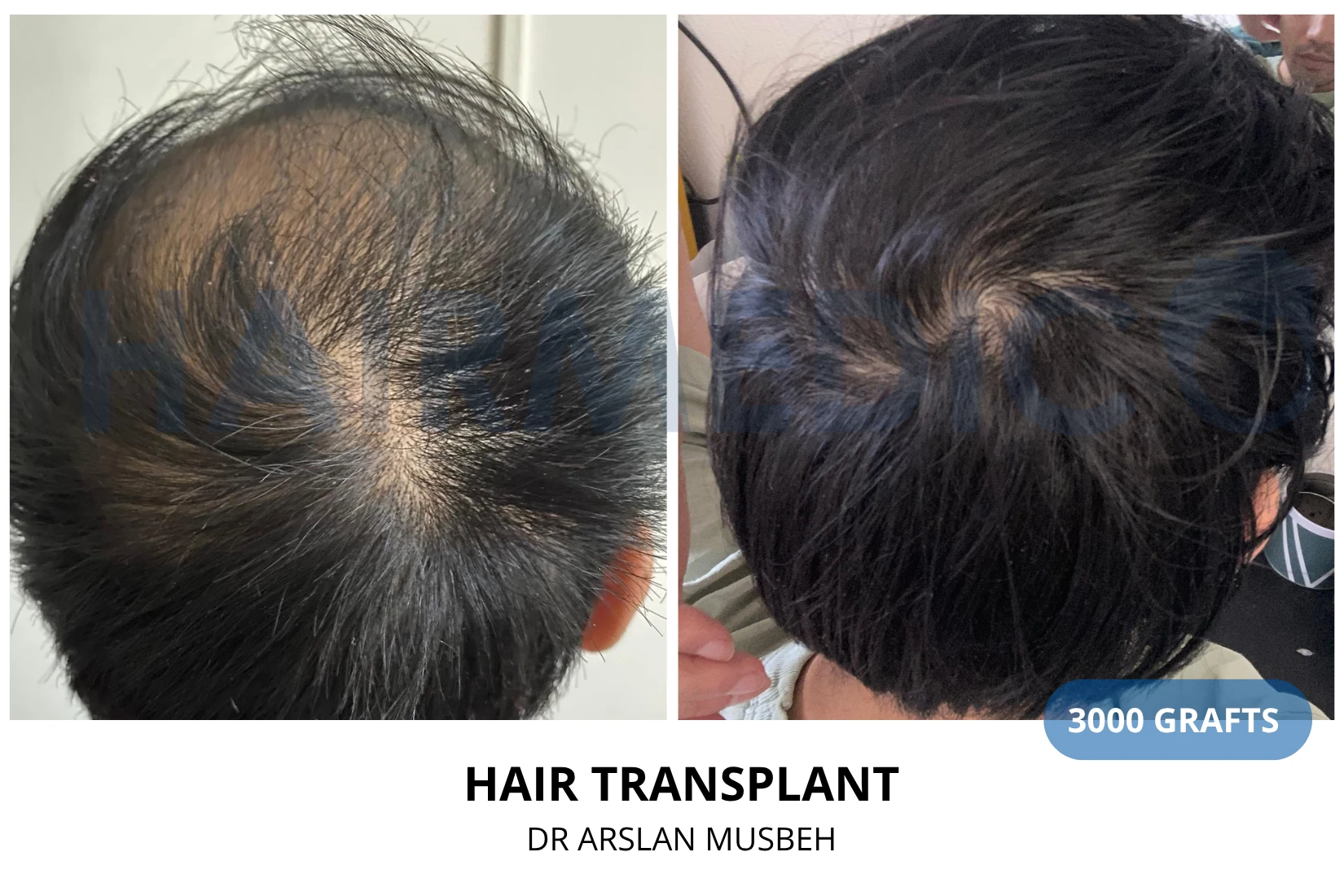 Hair transplant 3000 grafts FUE before and after at Hairmedico clinic by Dr. Arslan Musbeh in Istanbul