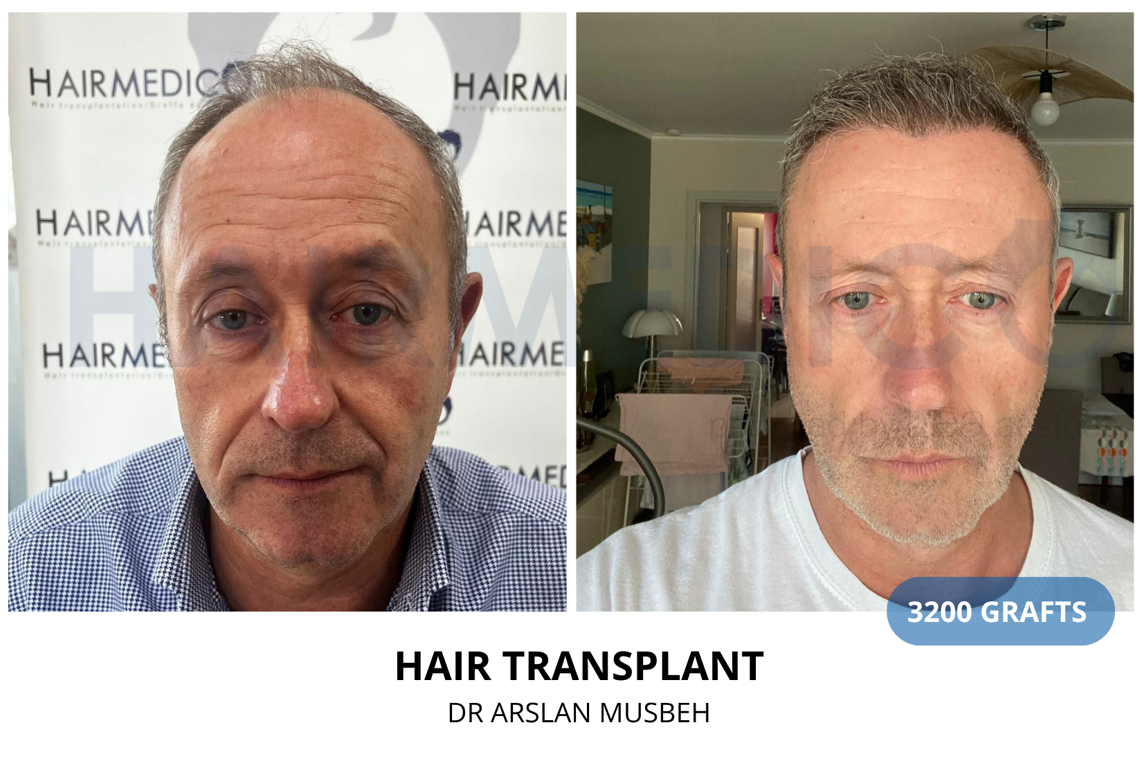 Risultato trapianto di capelli, 3200 graft, Dr. Arslan Musbeh