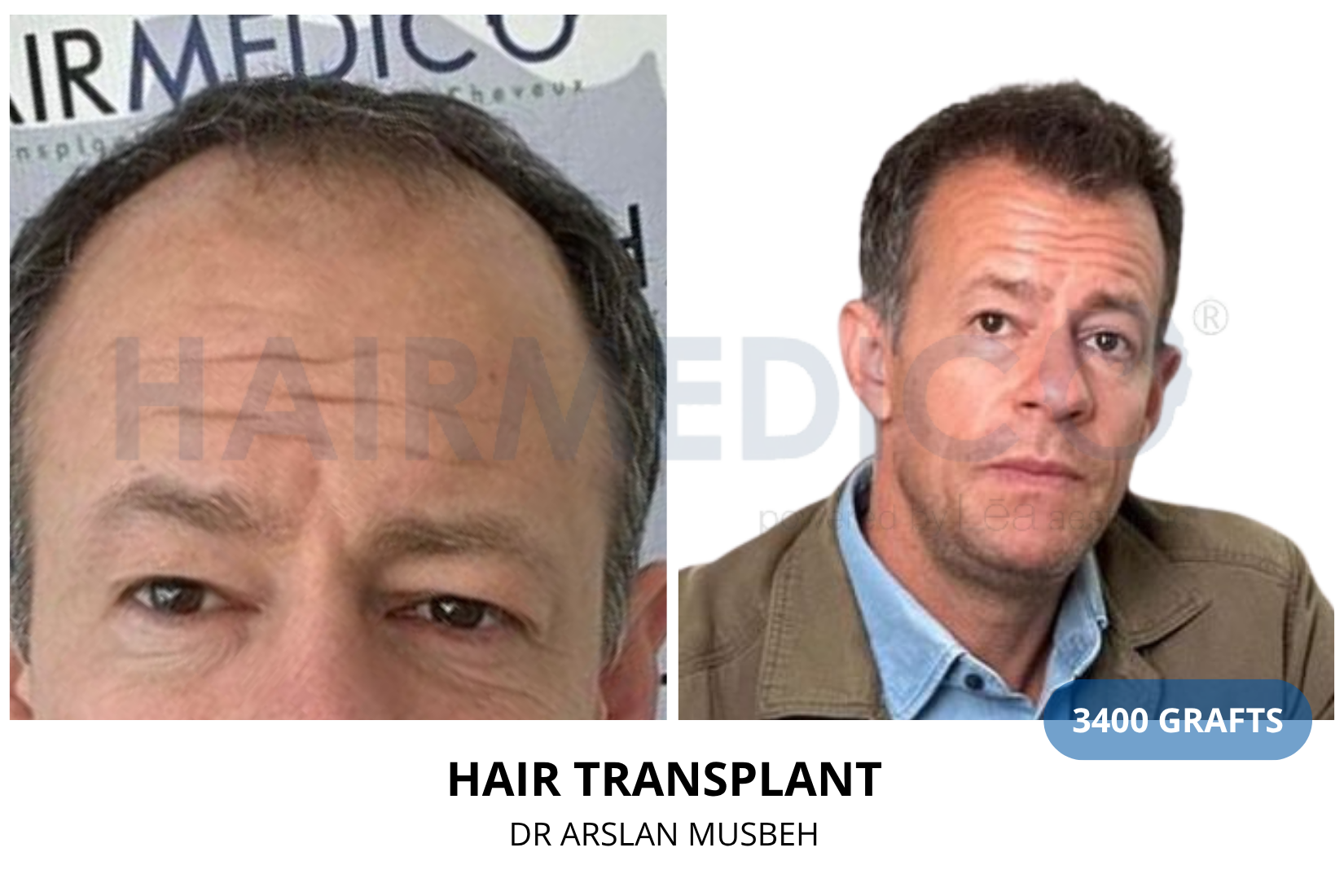 Risultato trapianto di capelli, 3400 graft, Dr. Arslan Musbeh