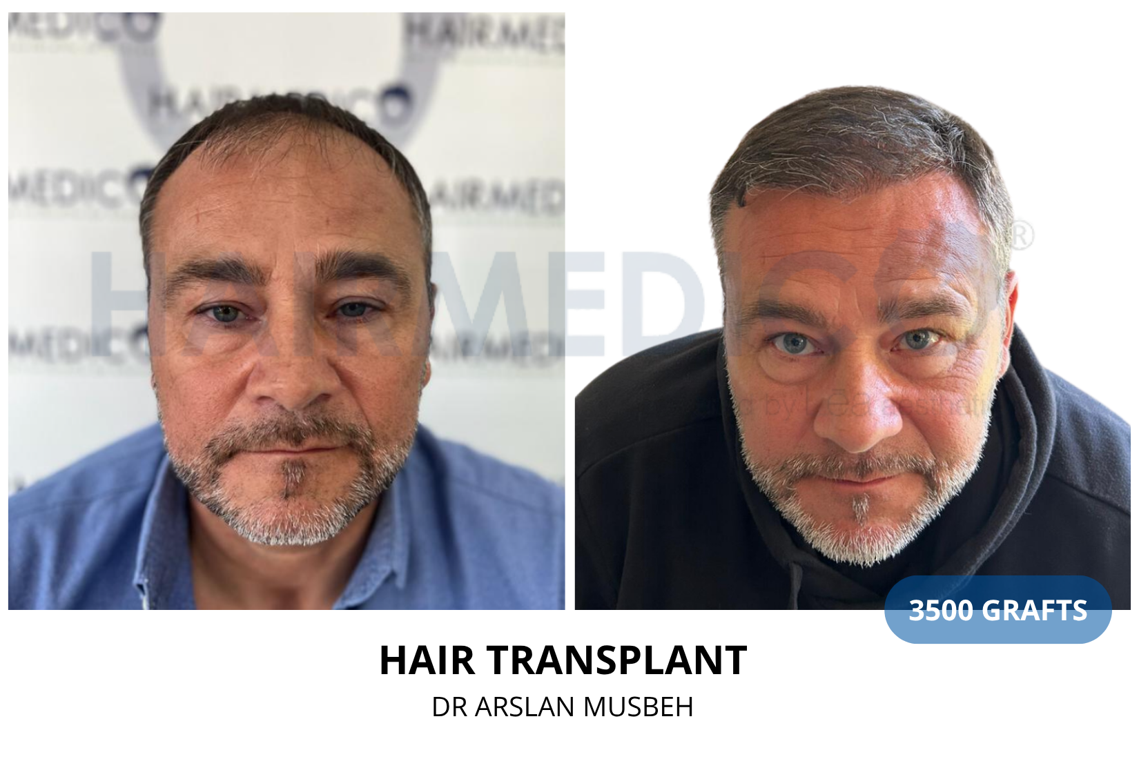 Risultato trapianto di capelli, 3500 graft, Dr. Arslan Musbeh
