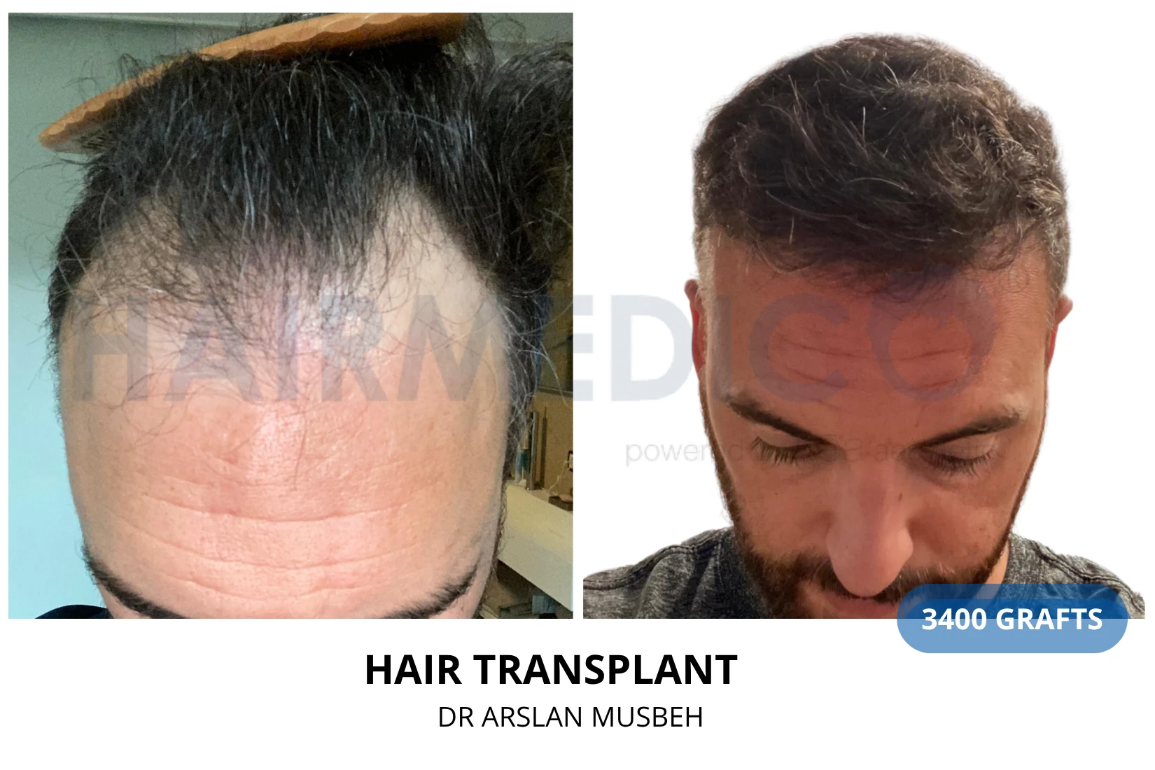 Hair transplant 3300 grafts FUE before and after at Hairmedico clinic by Dr. Arslan Musbeh in Istanbul