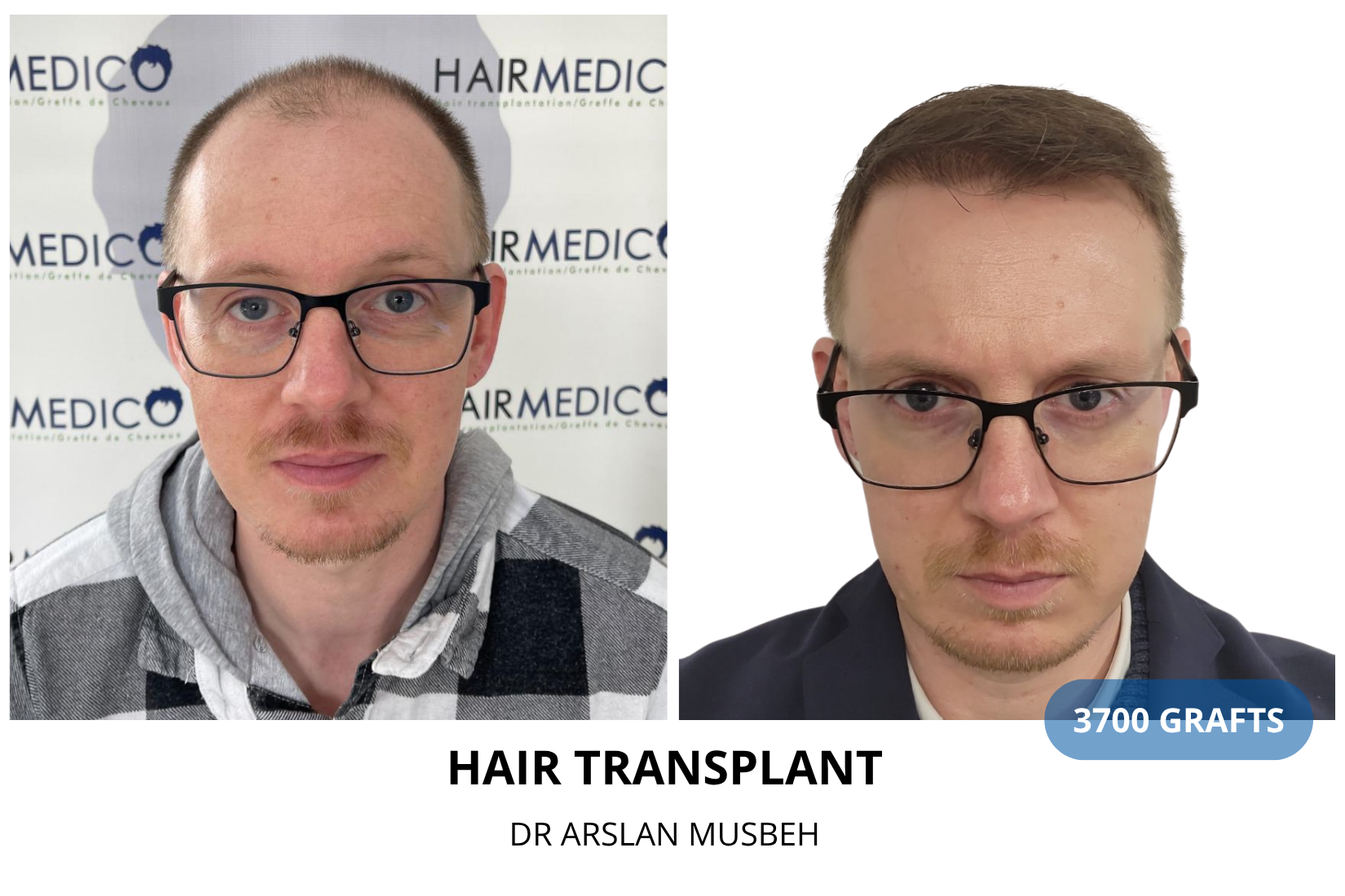 Risultato trapianto di capelli, 3700 graft, Dr. Arslan Musbeh
