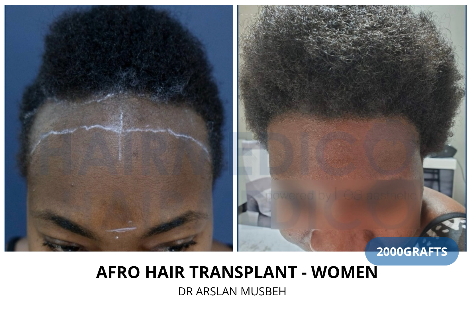 Risultato trapianto di capelli donna, 2000 graft, Dr. Arslan Musbeh