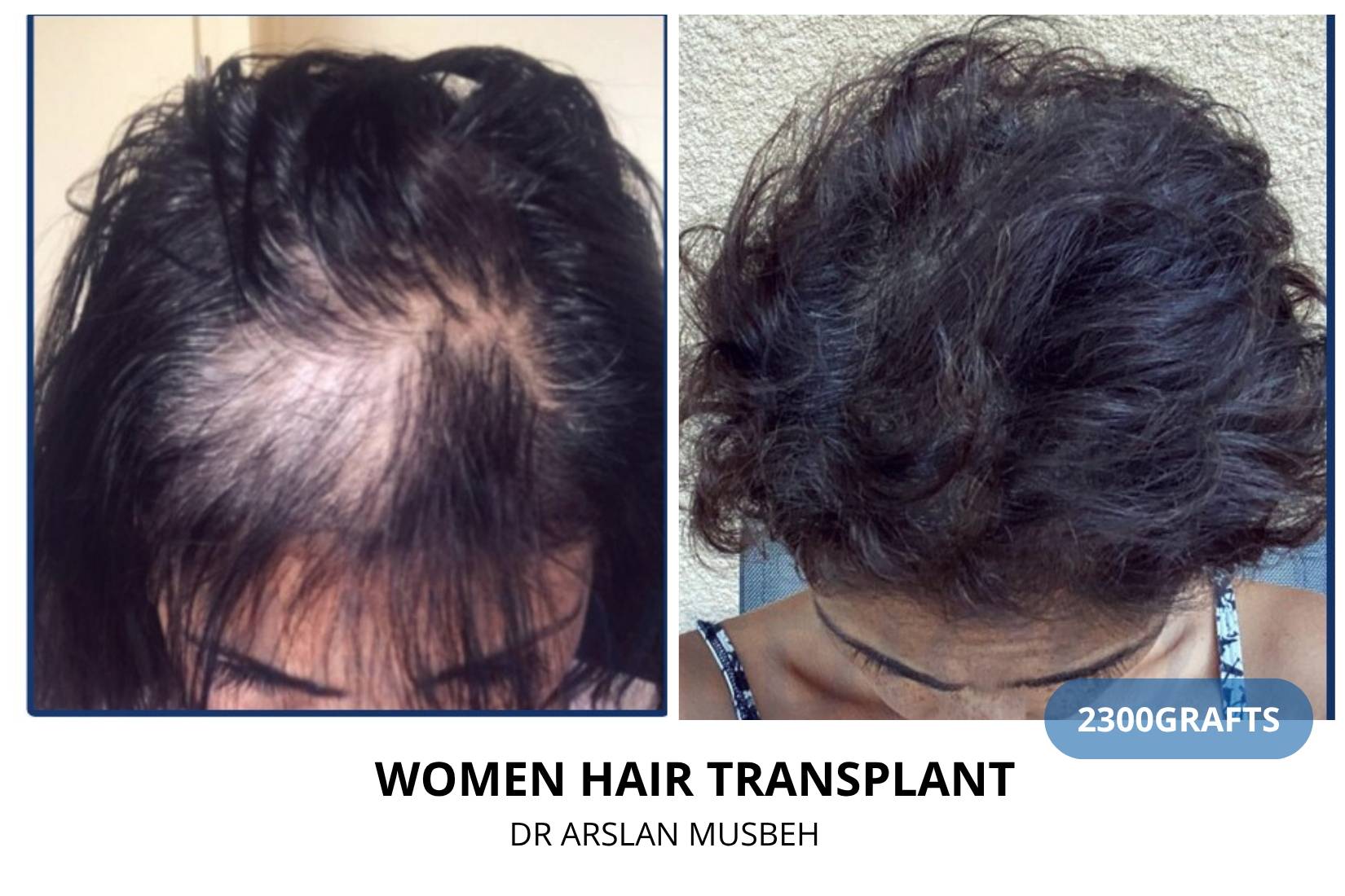 Trapianto di capelli donna - Risultato DHI, 2300 graft, Dr. Arslan Musbeh