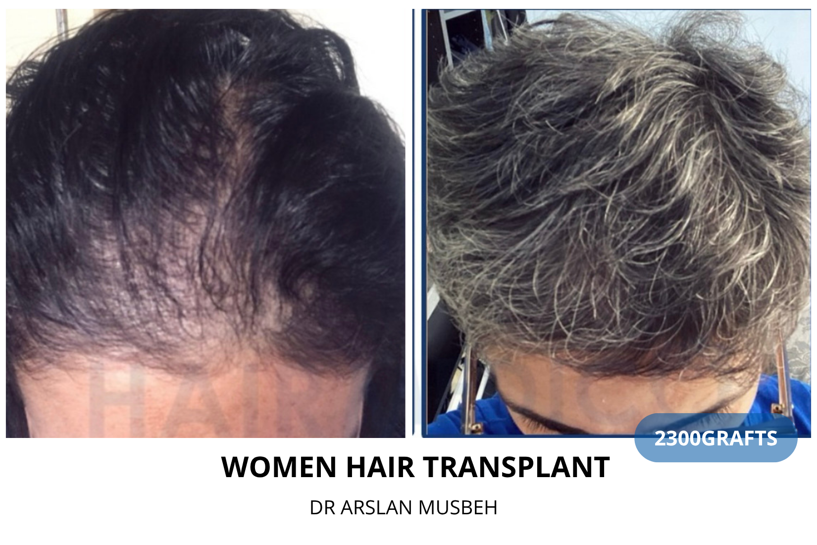 Trapianto di capelli donna - Risultato DHI, 2300 graft, Dr. Arslan Musbeh