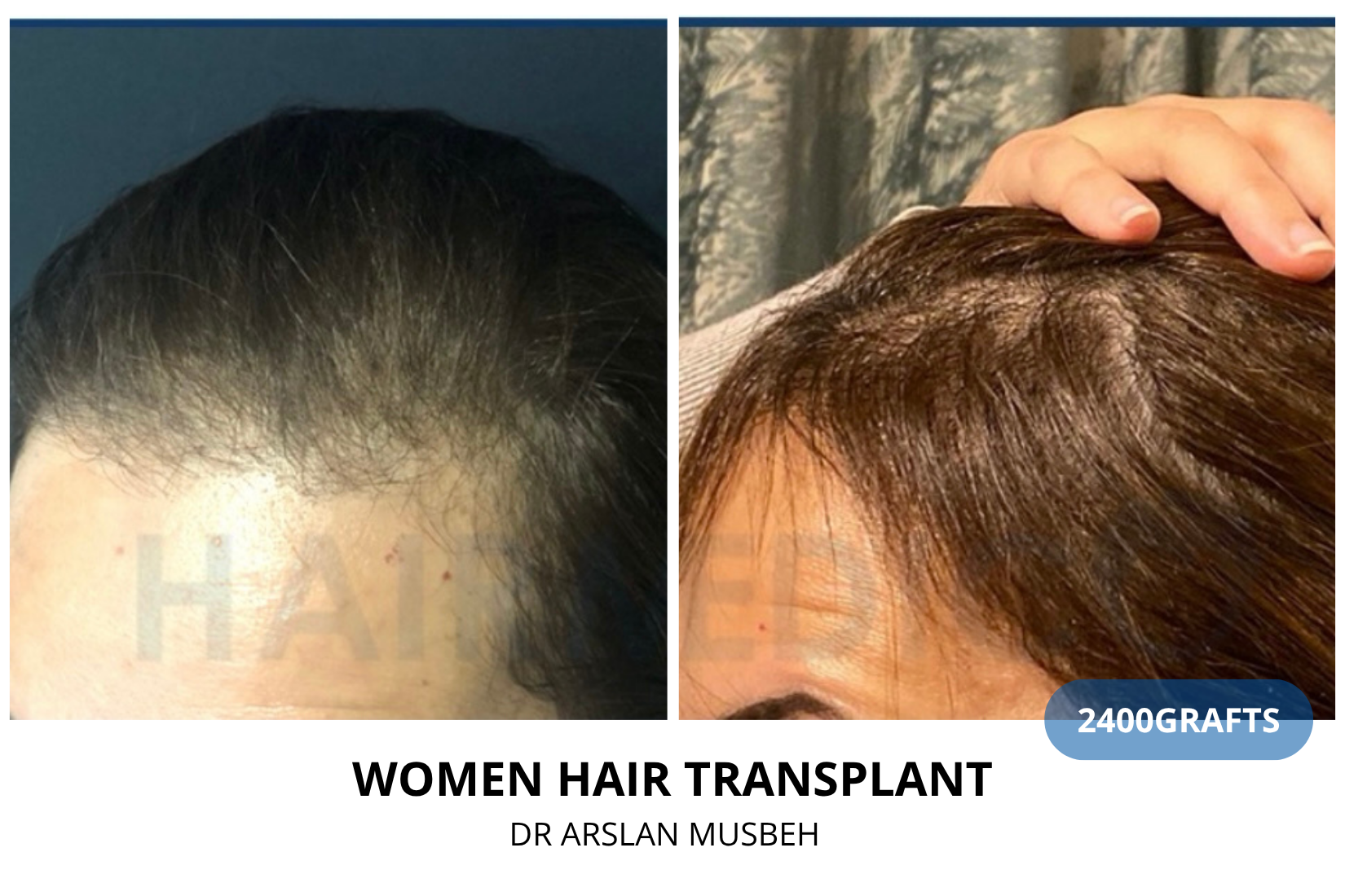 Trapianto di capelli donna - Risultato DHI, 2400 graft, Dr. Arslan Musbeh