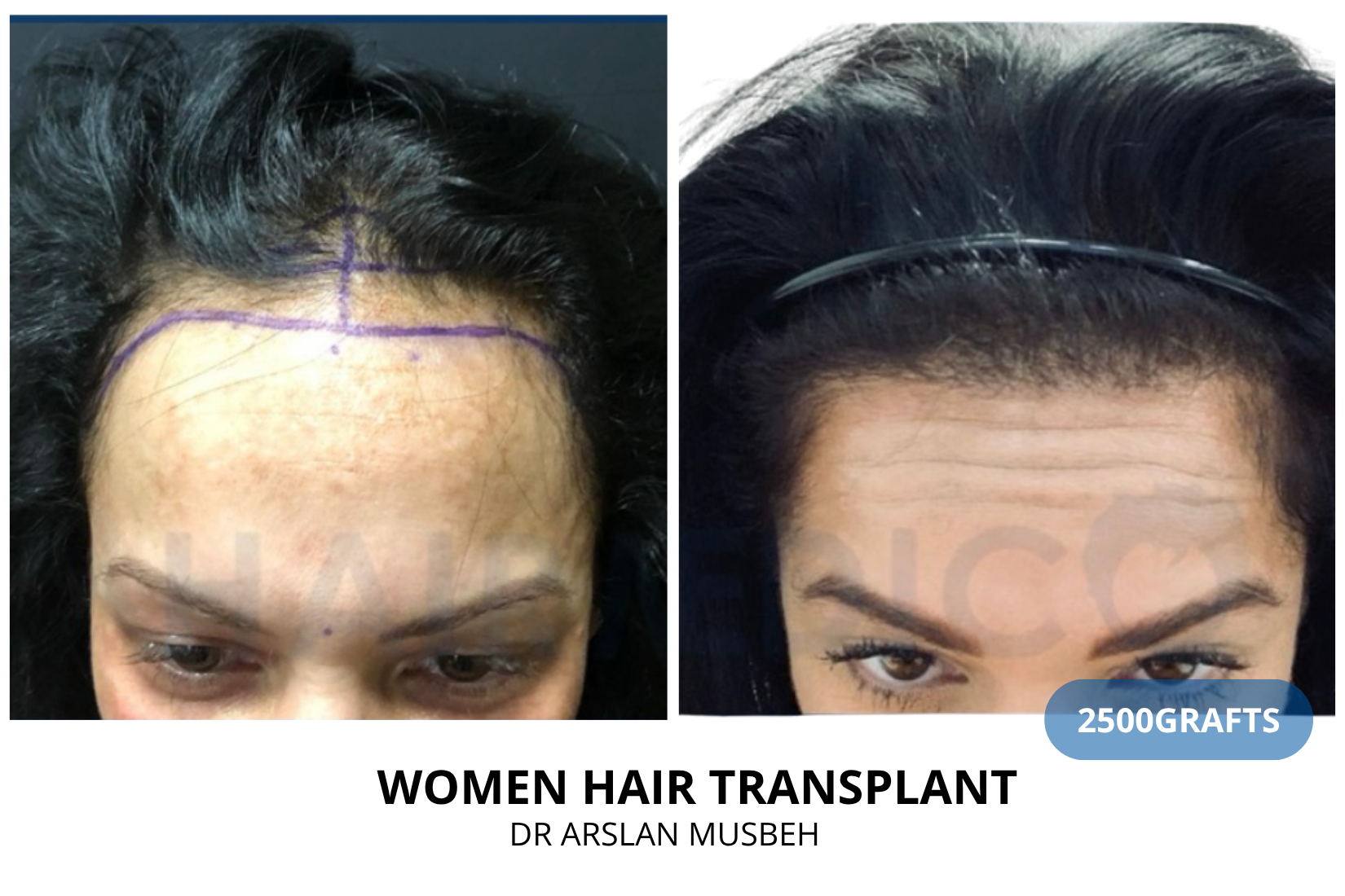 Trapianto di capelli donna - Risultato DHI, 2500 graft, Dr. Arslan Musbeh