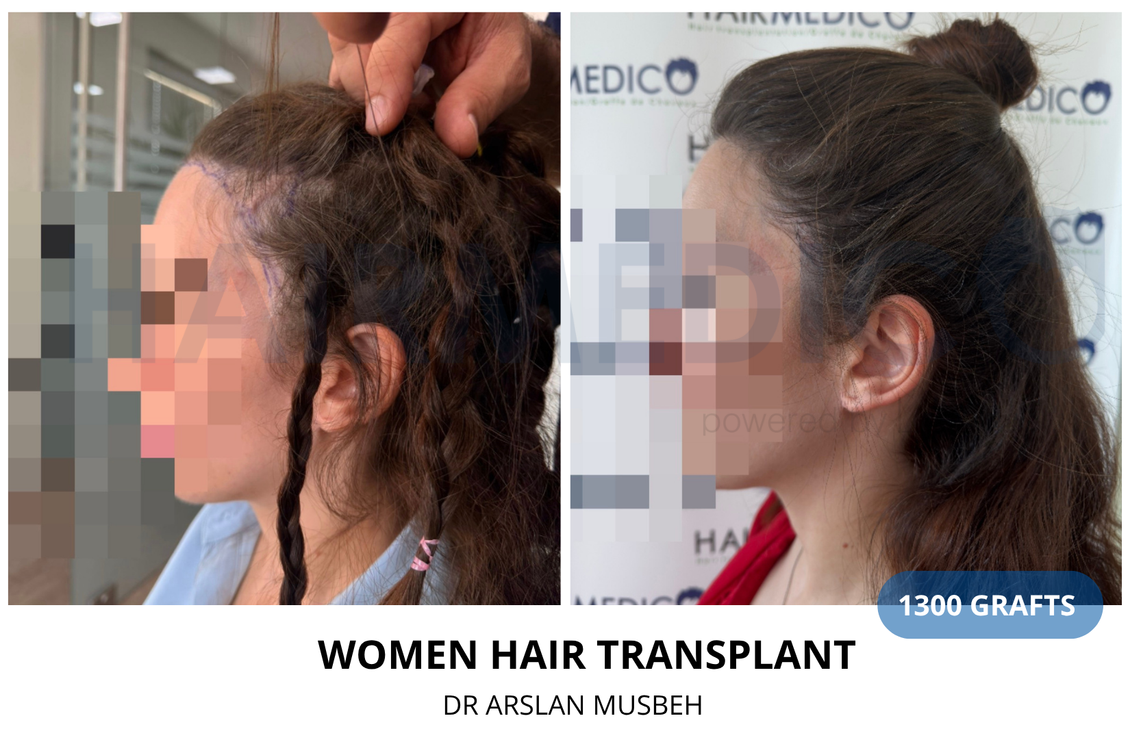 Trapianto di capelli donna - Risultato DHI, 1300 graft, Dr. Arslan Musbeh