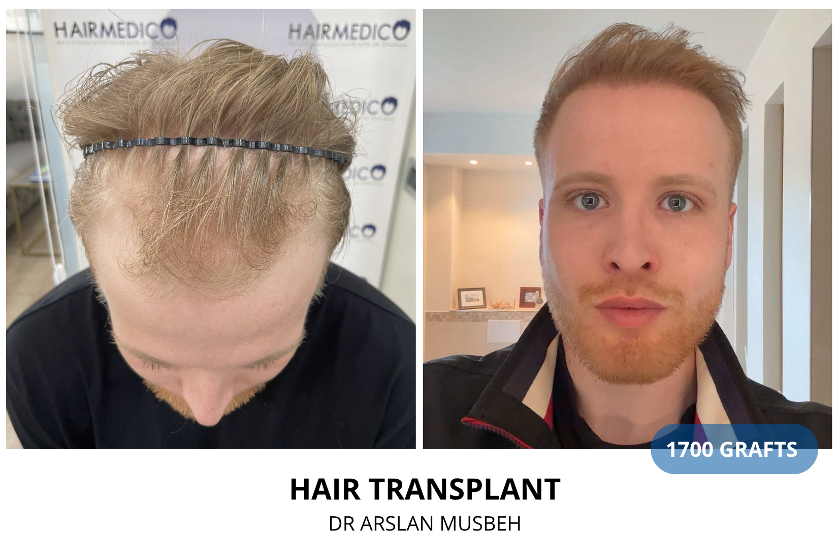 Risultato trapianto di capelli, 1700 graft, Dr. Arslan Musbeh