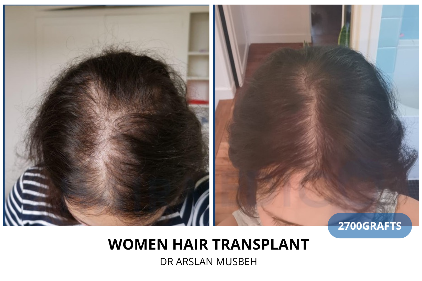 Risultato trapianto di capelli DHI donna, 2700 graft, Dr. Arslan Musbeh