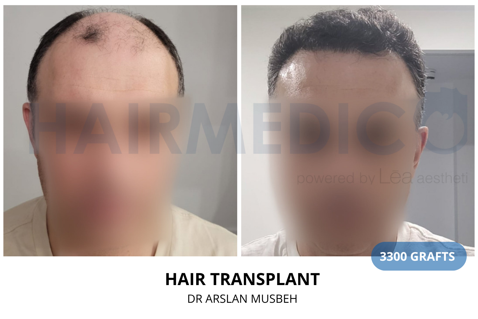 Risultato trapianto di capelli, 3300 graft, Dr. Arslan Musbeh