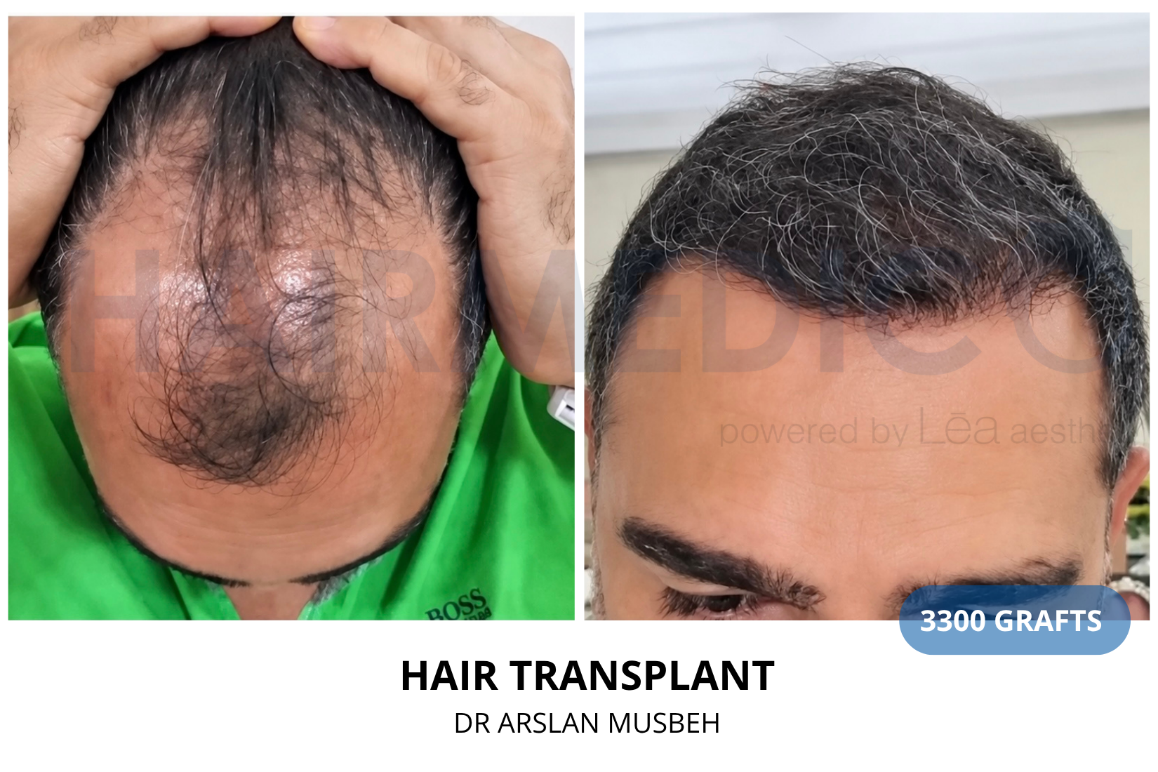Risultato trapianto di capelli, 3300 graft, Dr. Arslan Musbeh