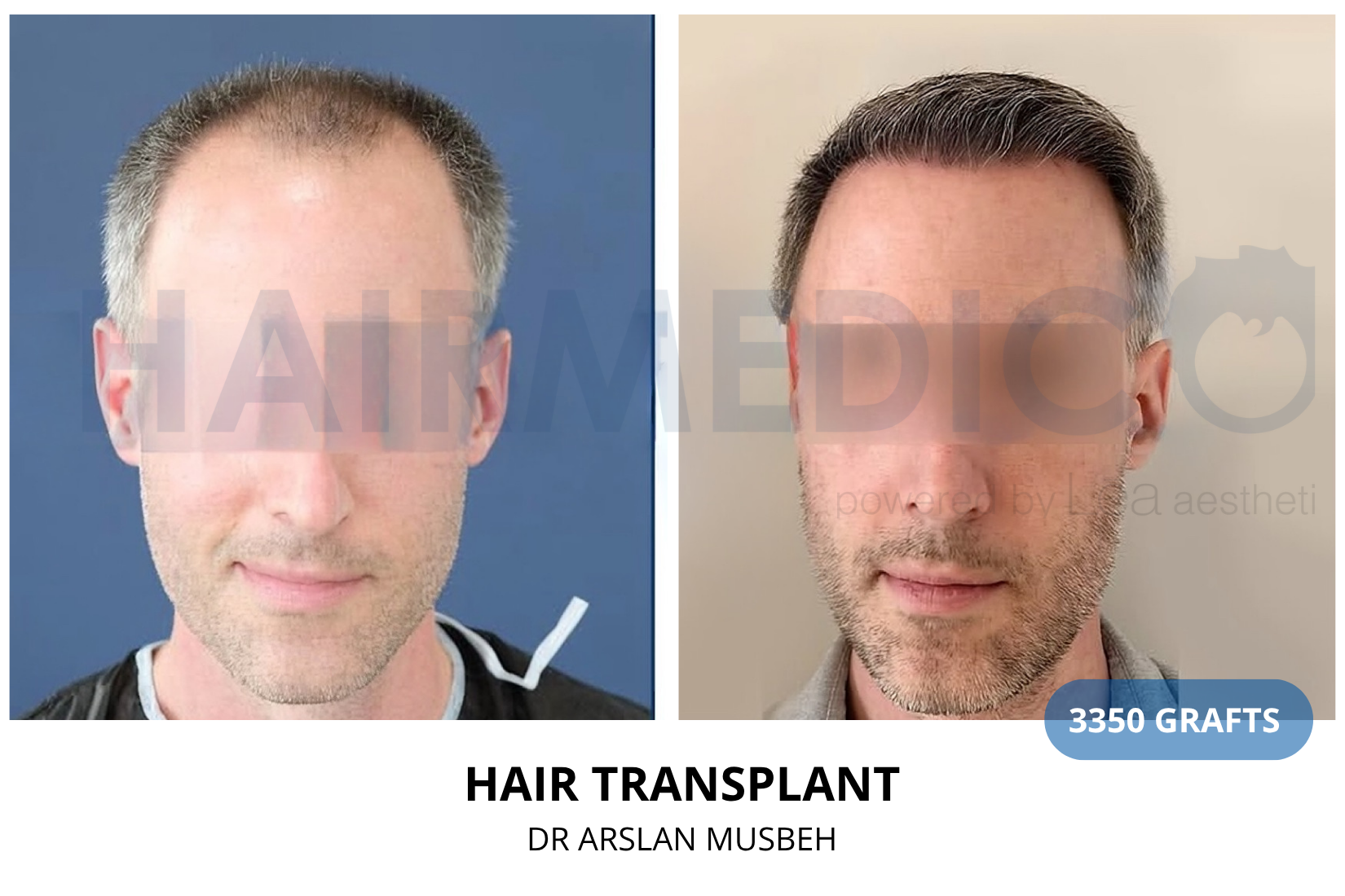 Risultato trapianto di capelli, 3350 graft, Dr. Arslan Musbeh