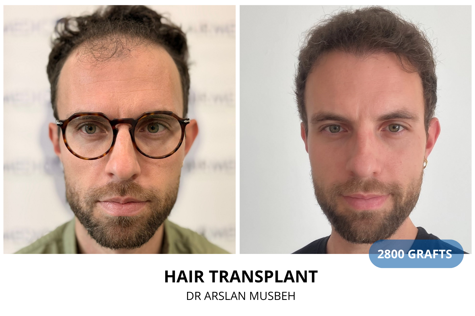 Risultato trapianto di capelli, 2800 graft, Dr. Arslan Musbeh