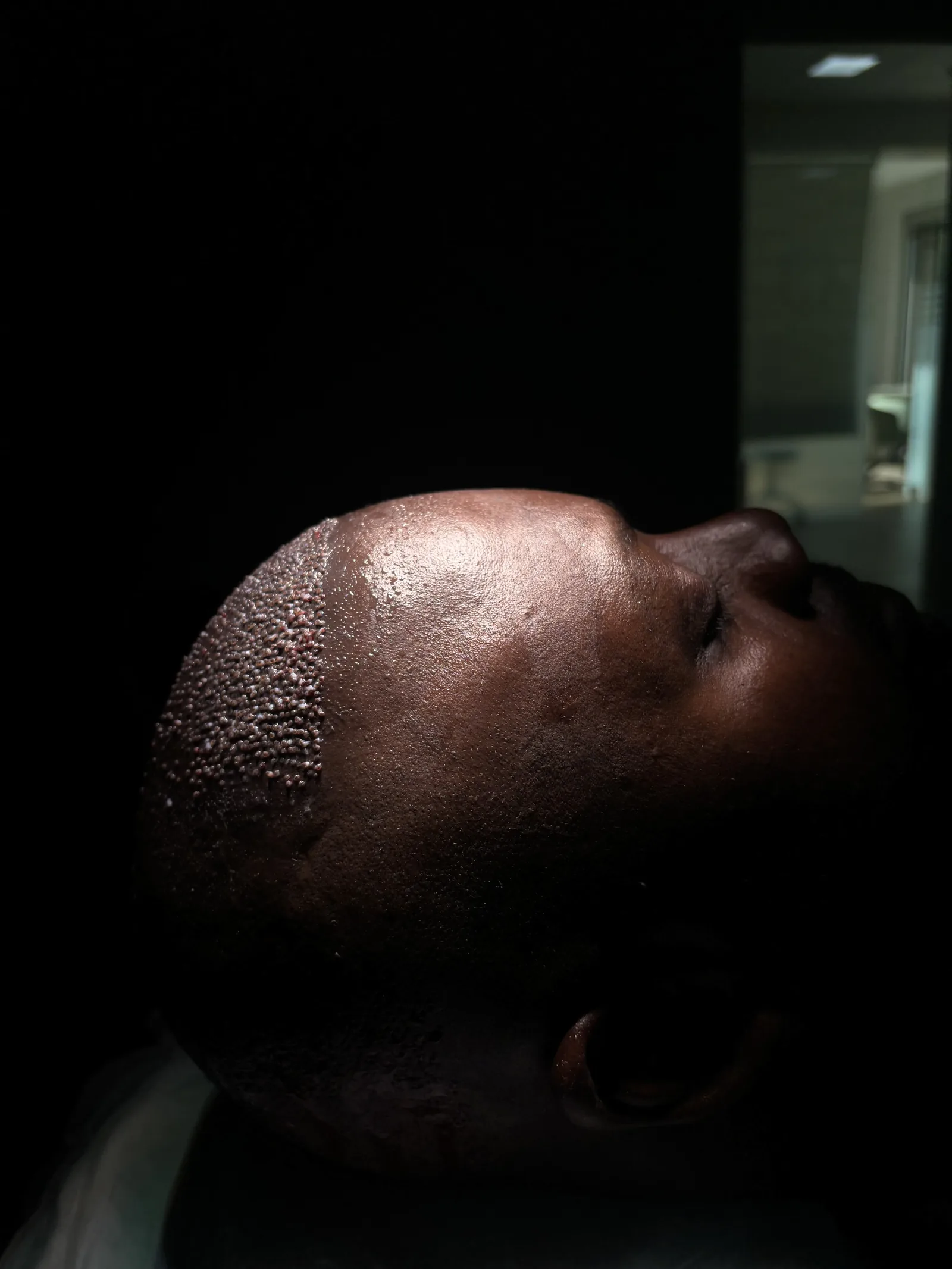 Donor area on afro-textured hair immediately after FUE extraction at Hairmedico Istanbul