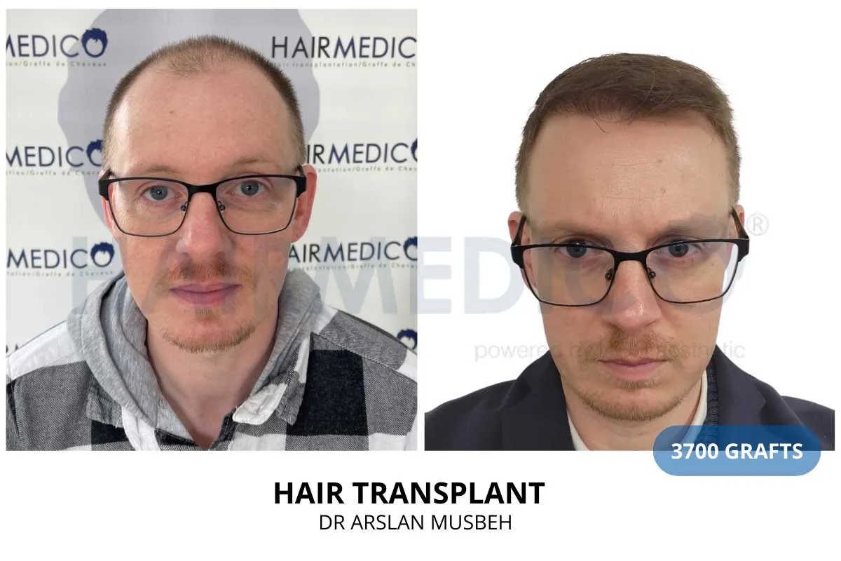 Hair transplant before and after — 3700