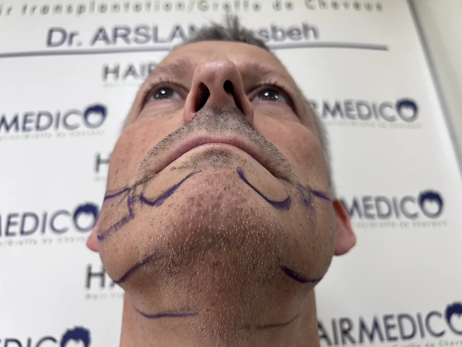 Beard transplant pre-operative design — natural beard line hand-marked on the chin and jaw before graft extraction