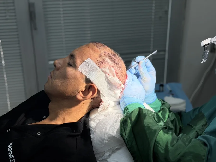 Close-up of Dr. Arslan Musbeh's hands during a graft placement procedure at Hairmedico Istanbul
