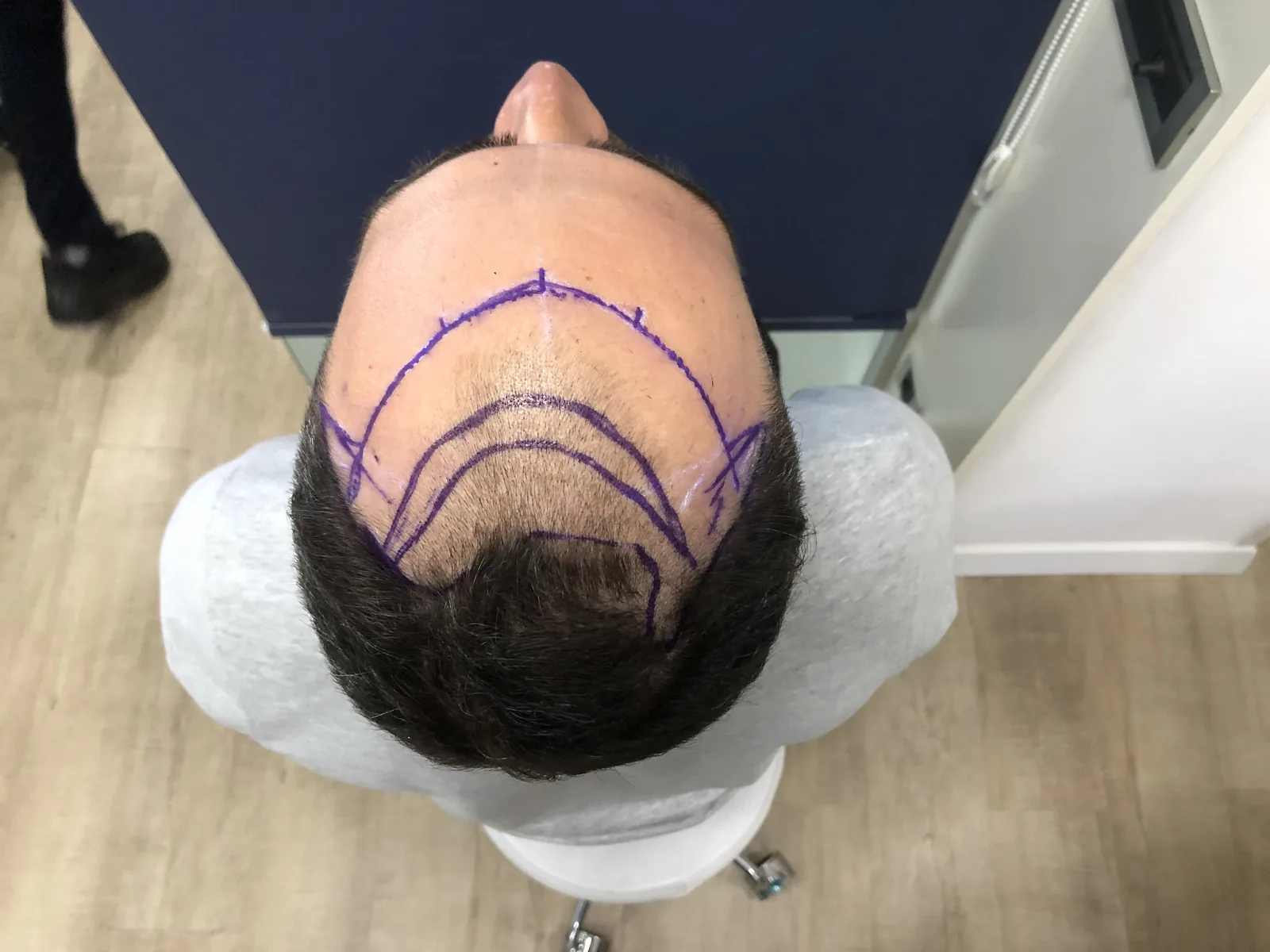 Overhead view of a patient's scalp with two hairline positions marked in surgical pen before a procedure