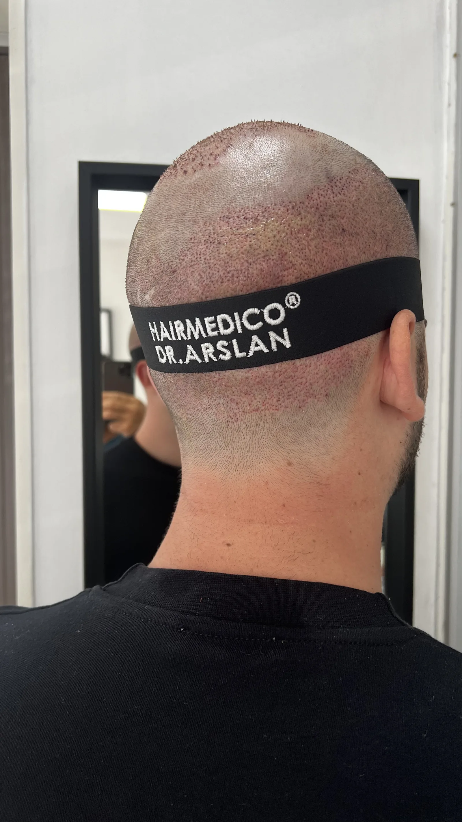 Donor area at the back of the head immediately after FUE extraction at Hairmedico