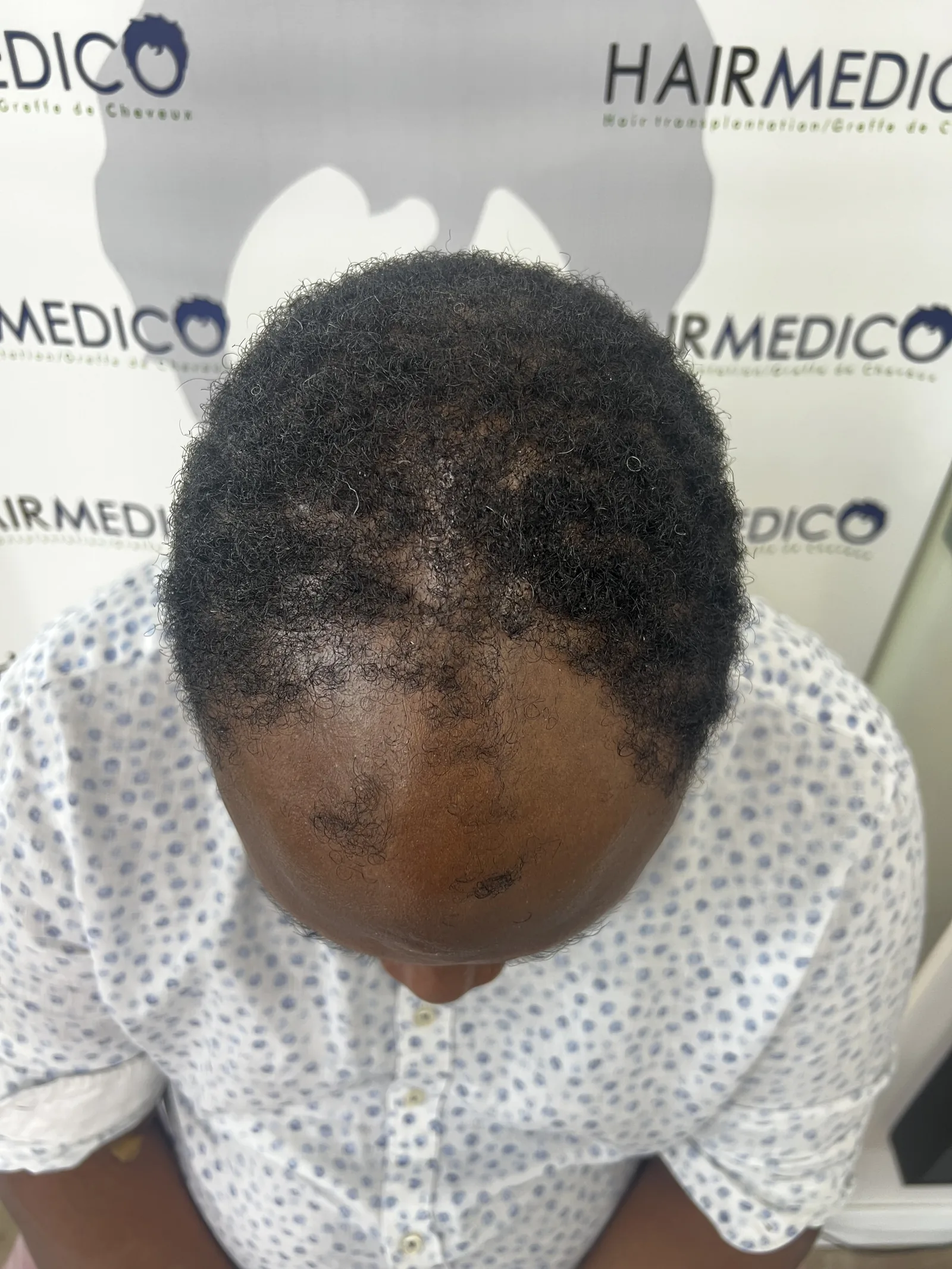 Close-up documentation photograph of a patient's scalp and hairline, taken under studio lighting at Hairmedico