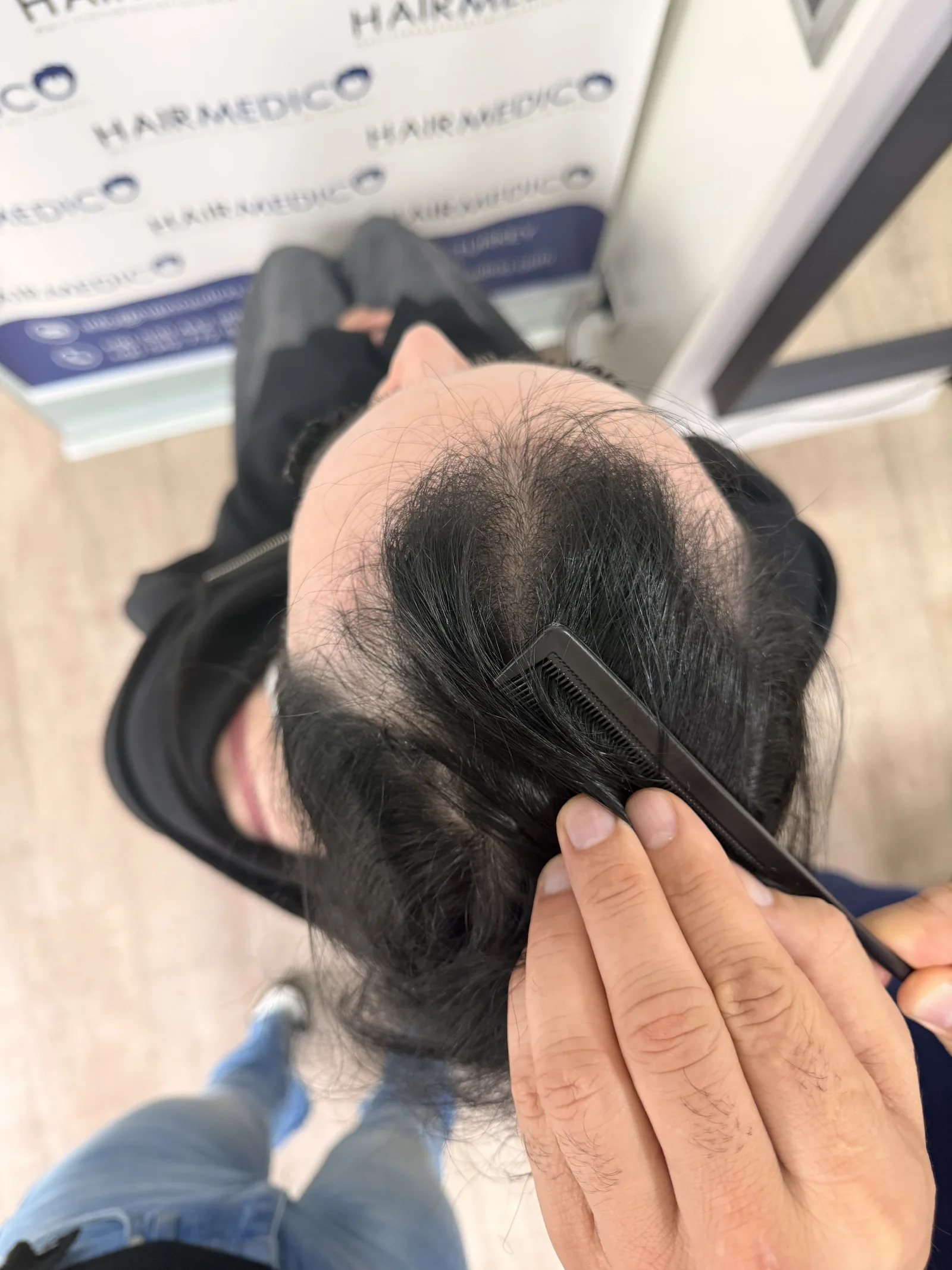 Hairline assessment at Hairmedico Istanbul — checking hair direction and density along the frontal edge