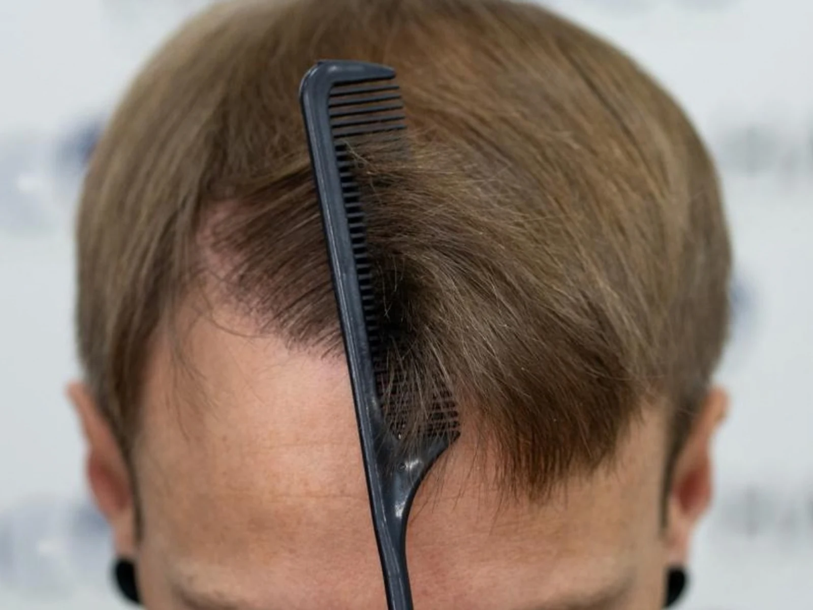 Close-up of a fully grown hairline at 12 months after a hair transplant, parted with a comb to show density