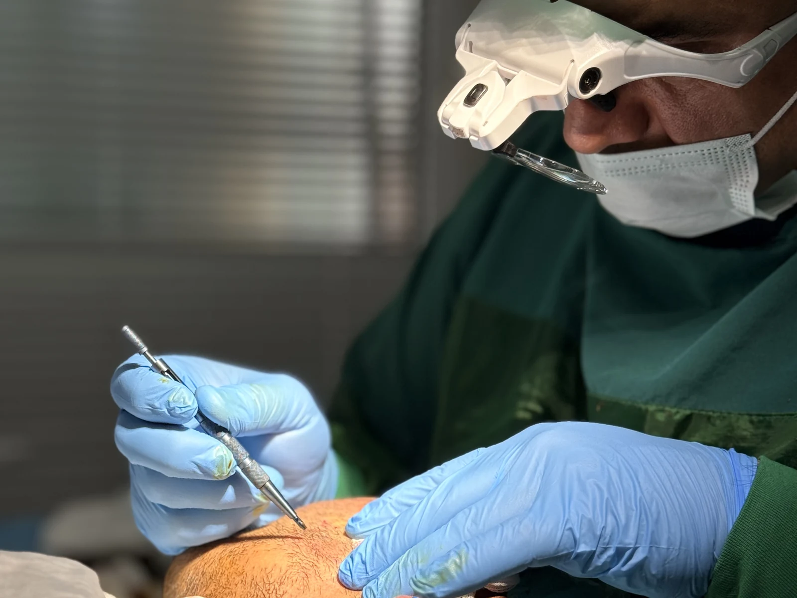 Close-up of Dr. Arslan Musbeh opening recipient channels with a fine sapphire-tipped instrument during an FUE procedure