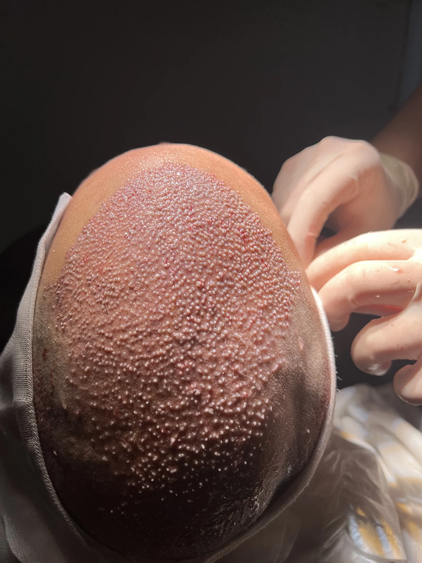 Close-up of a patient's scalp during FUE extraction at Hairmedico, showing individually removed follicular units