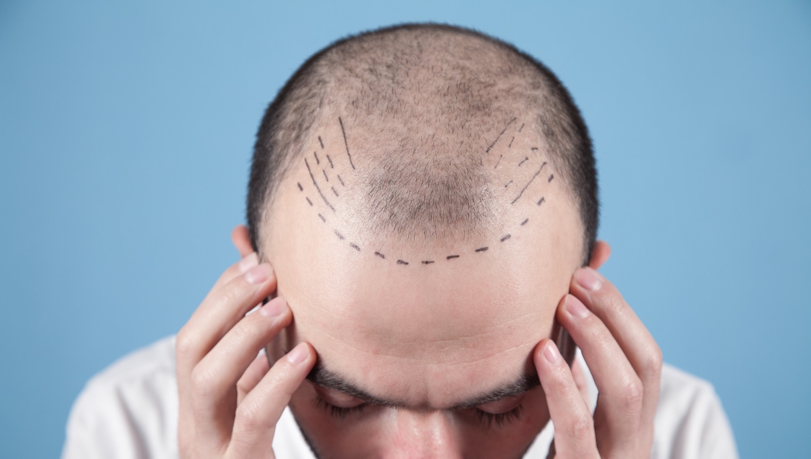 Hairline Design Hair Transplant Guide — Hairmedico Istanbul