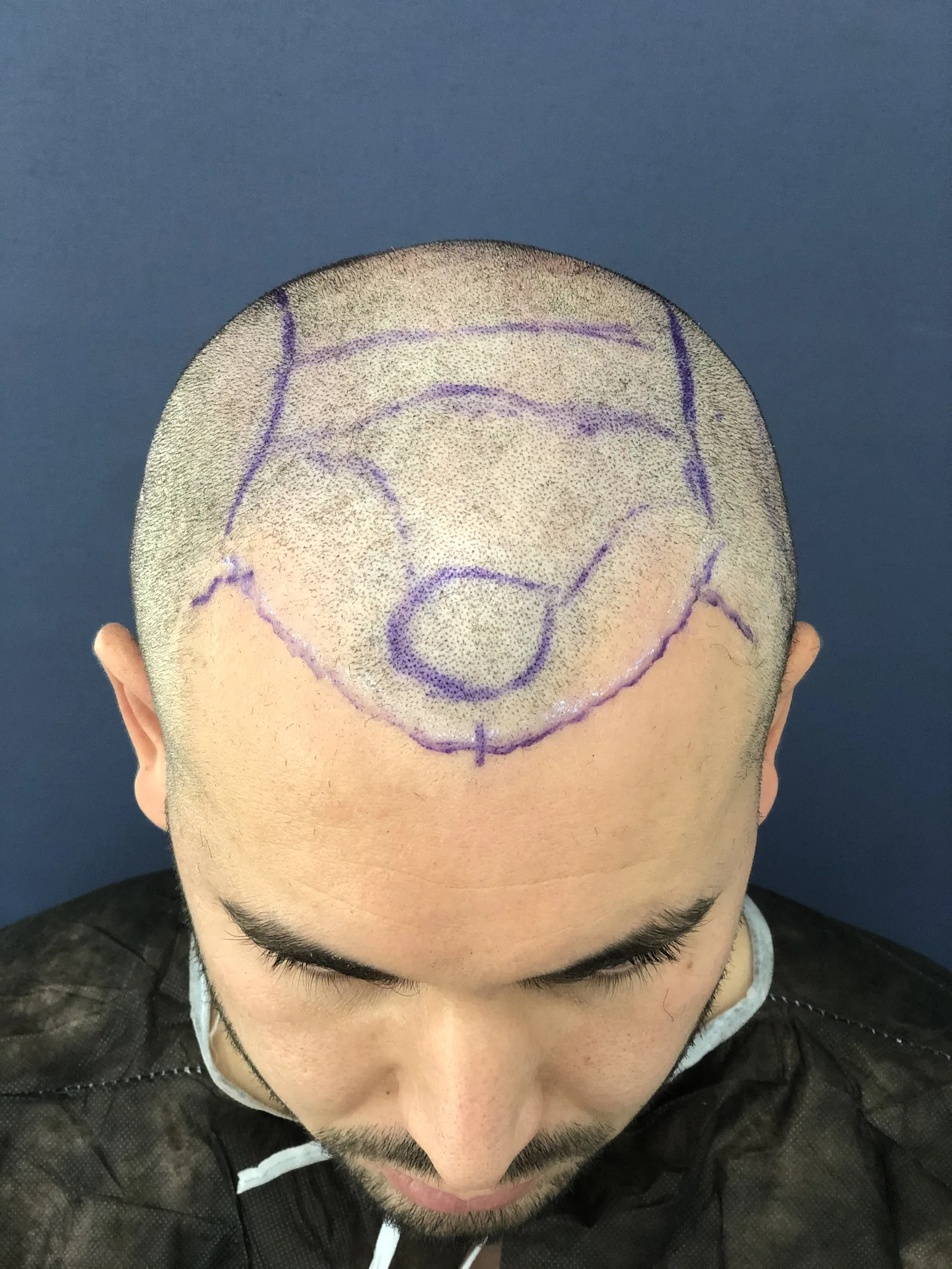 Close-up of a hairline and crown area marked in surgical pen ahead of a hair transplant procedure