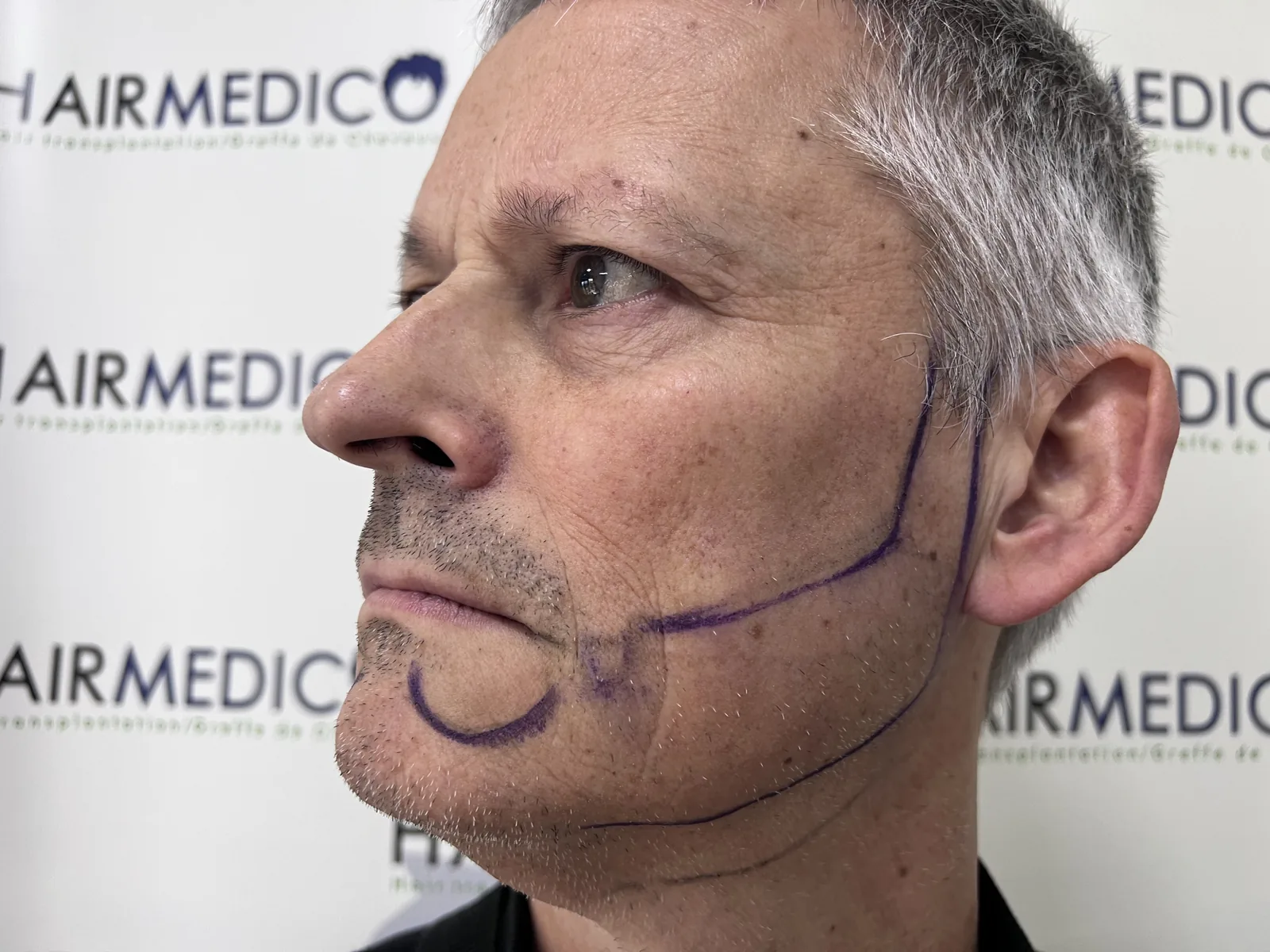 Pre-operative markings on a beard transplant patient at the Hairmedico clinic