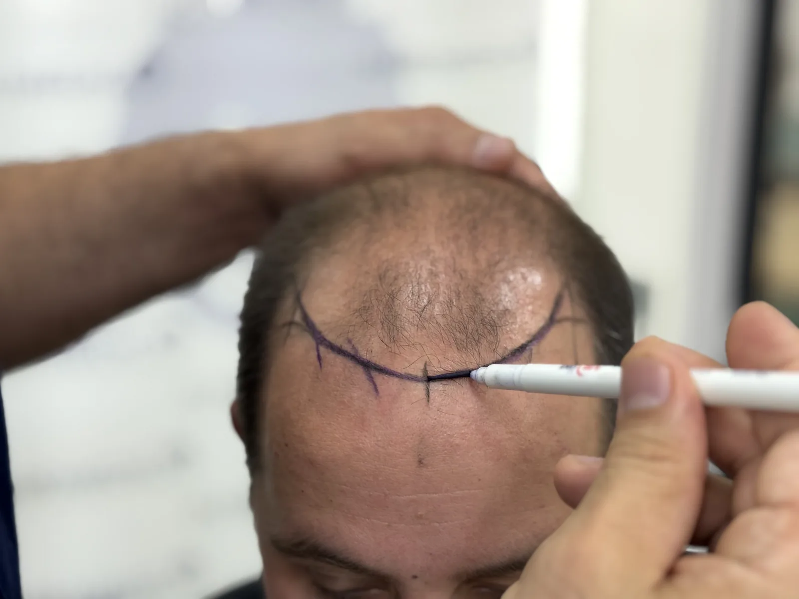 Hairline plan marked out on a patient before surgery