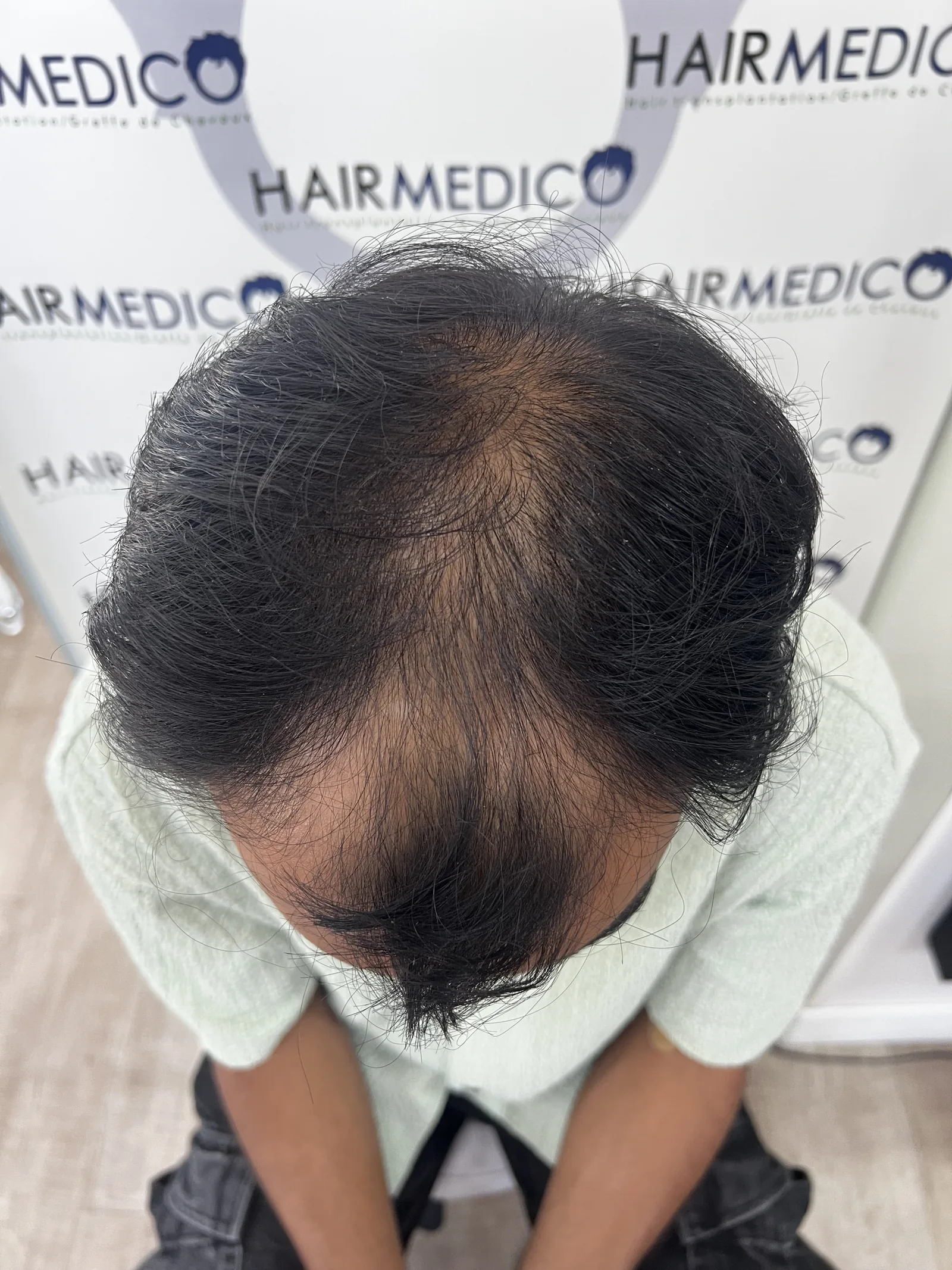 Overhead view of a patient's crown examined during a hair transplant consultation at Hairmedico