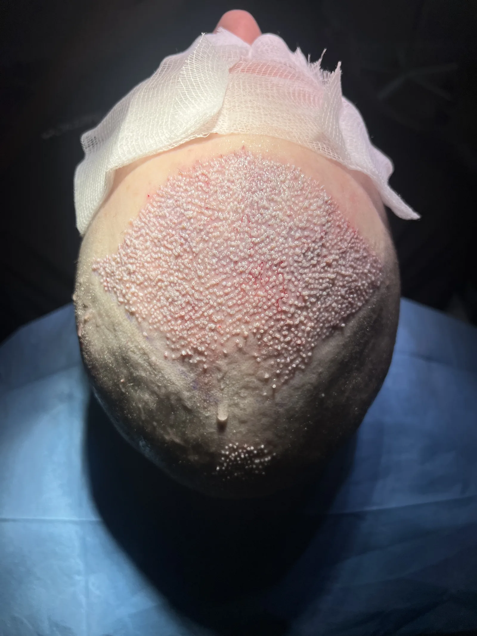 Donor area at the back of the scalp shortly after FUE extraction, showing even follicle spacing